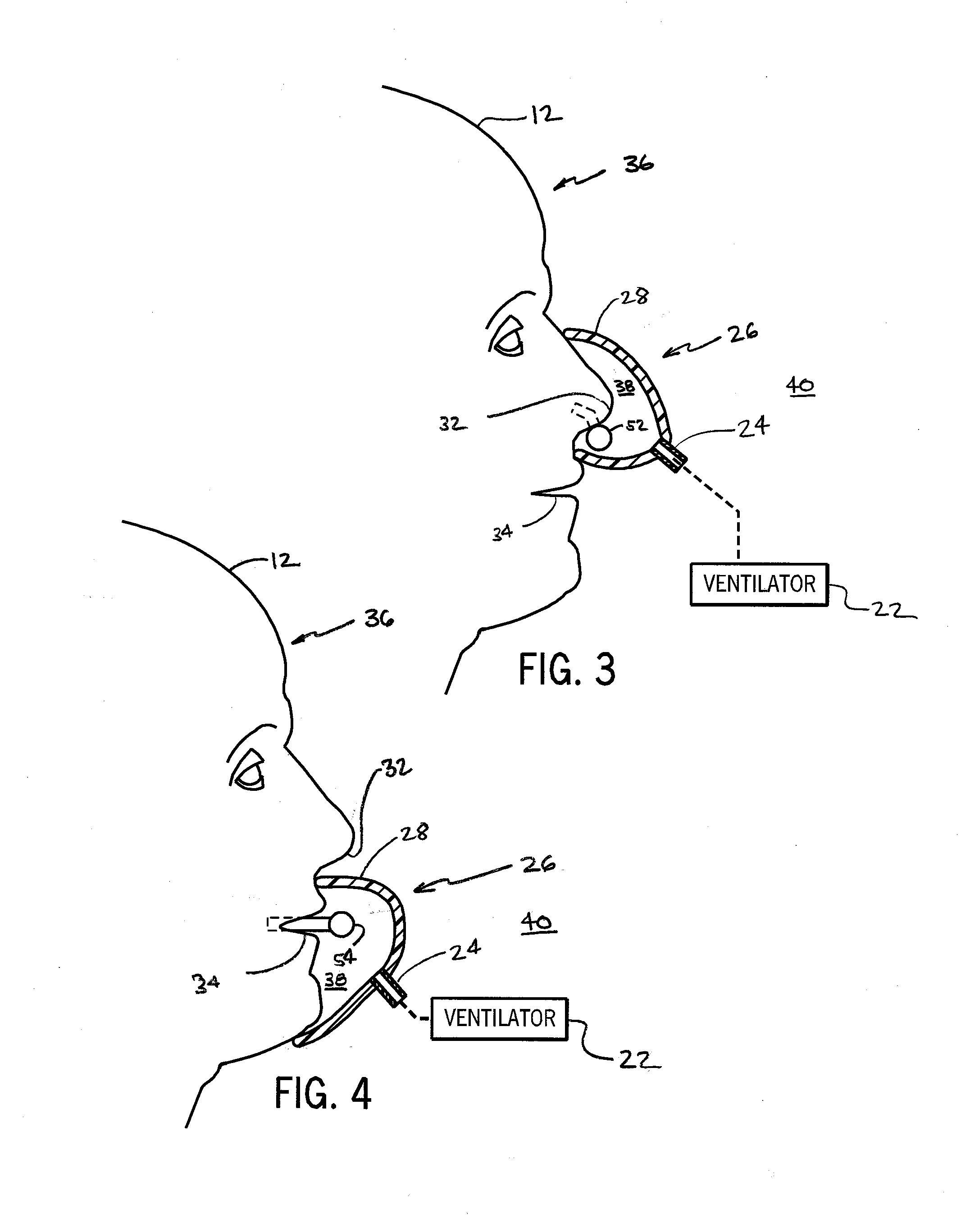 Respiratory monitoring with cannula receiving respiratory airflows, differential pressure transducer, and ventilator