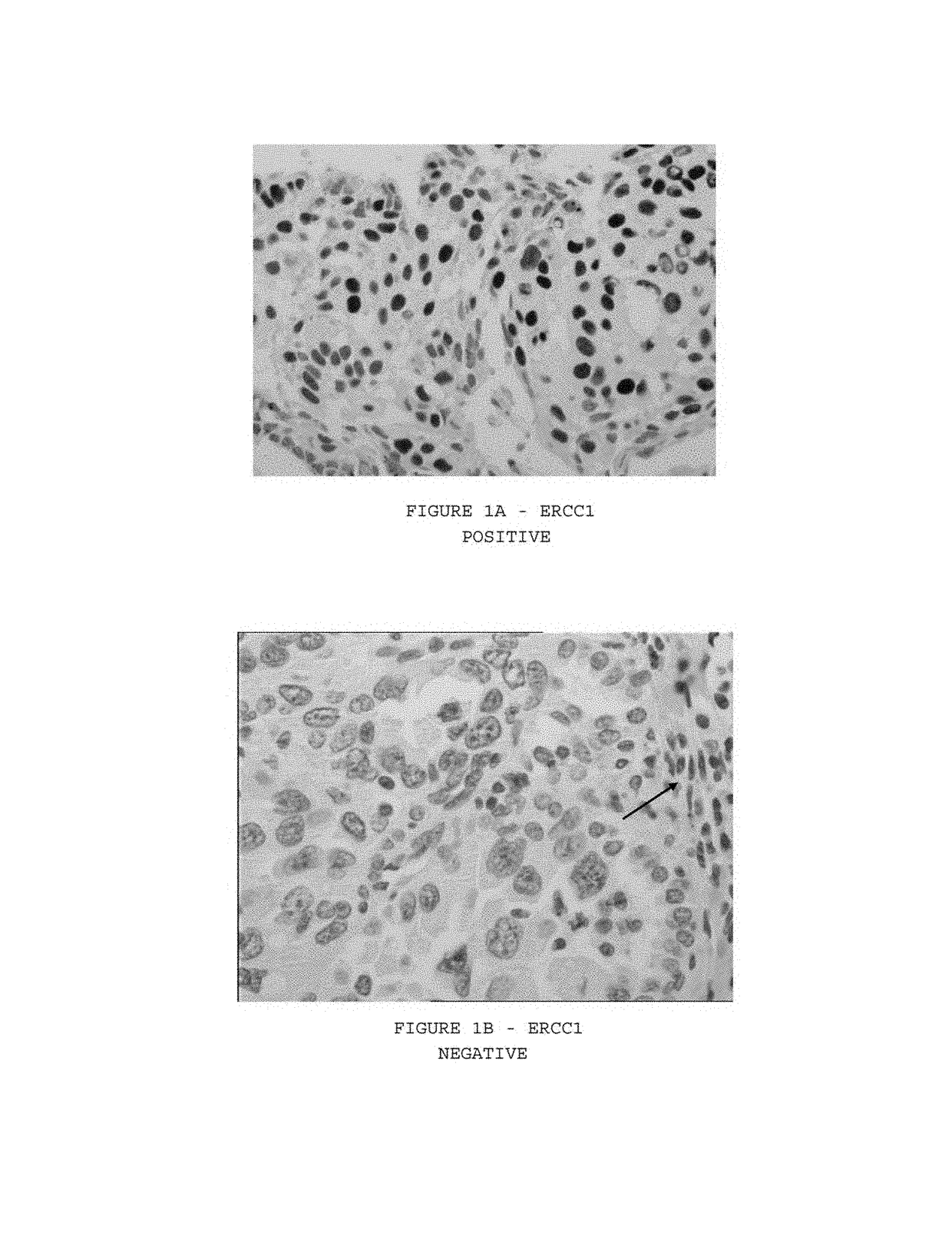 Expression of isoform 202 of ERCC1 for predicting response to cancer chemotherapy