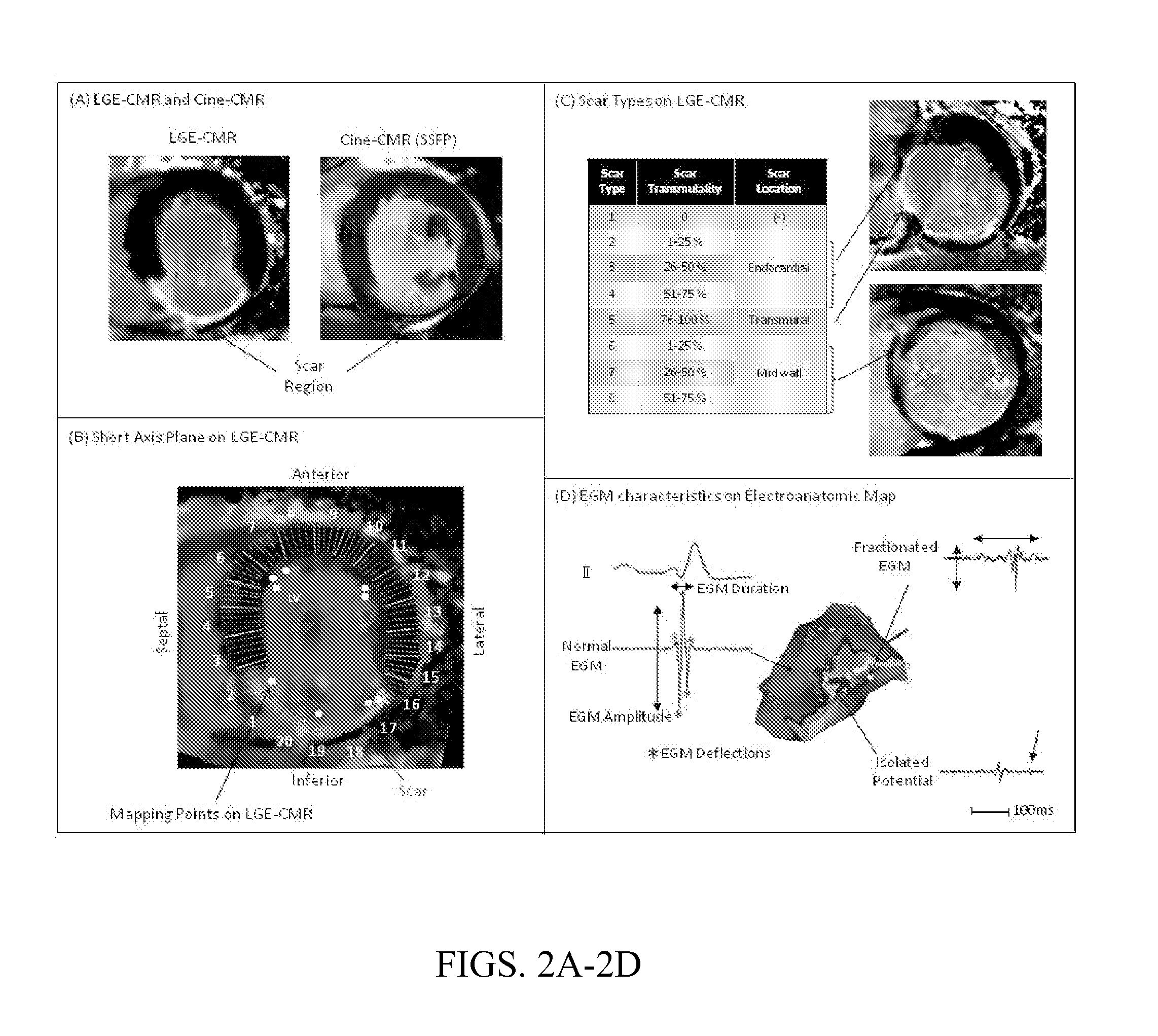 Non-invasive methods and systems for producing cardiac electrogram characteristic maps for use with catheter ablation of ventricular tachycardia