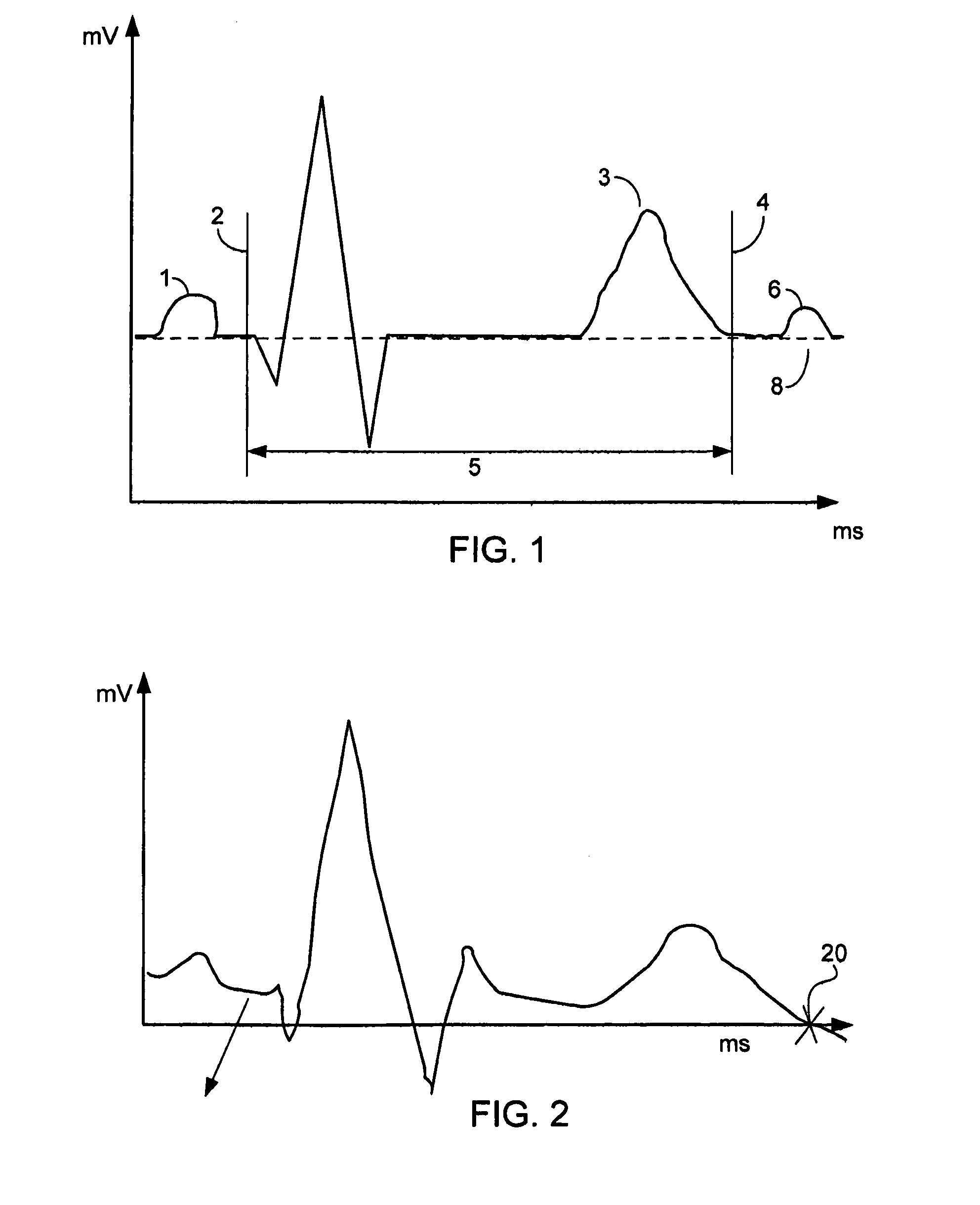 QT-interval measurement in the electrocardiogram