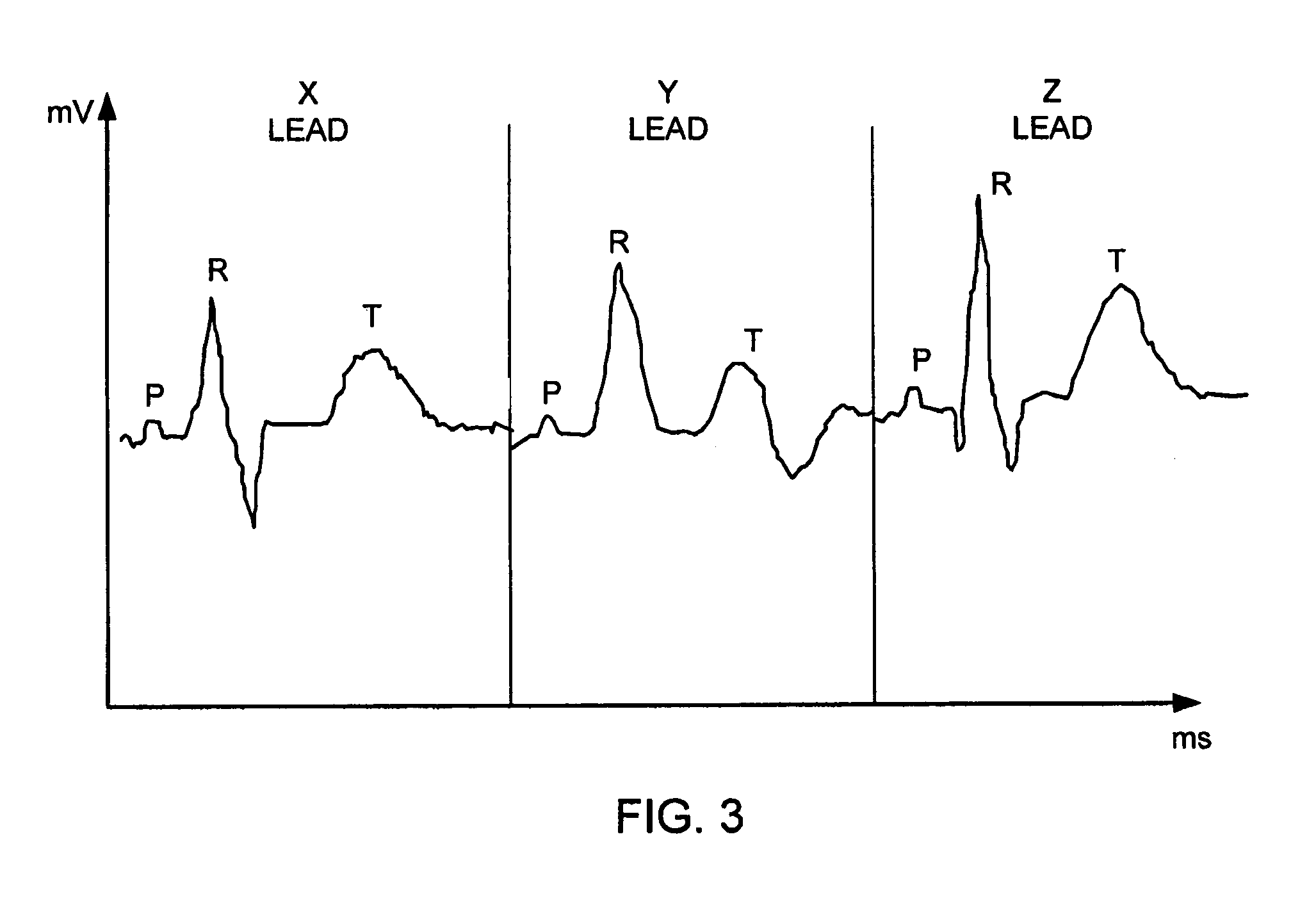 QT-interval measurement in the electrocardiogram