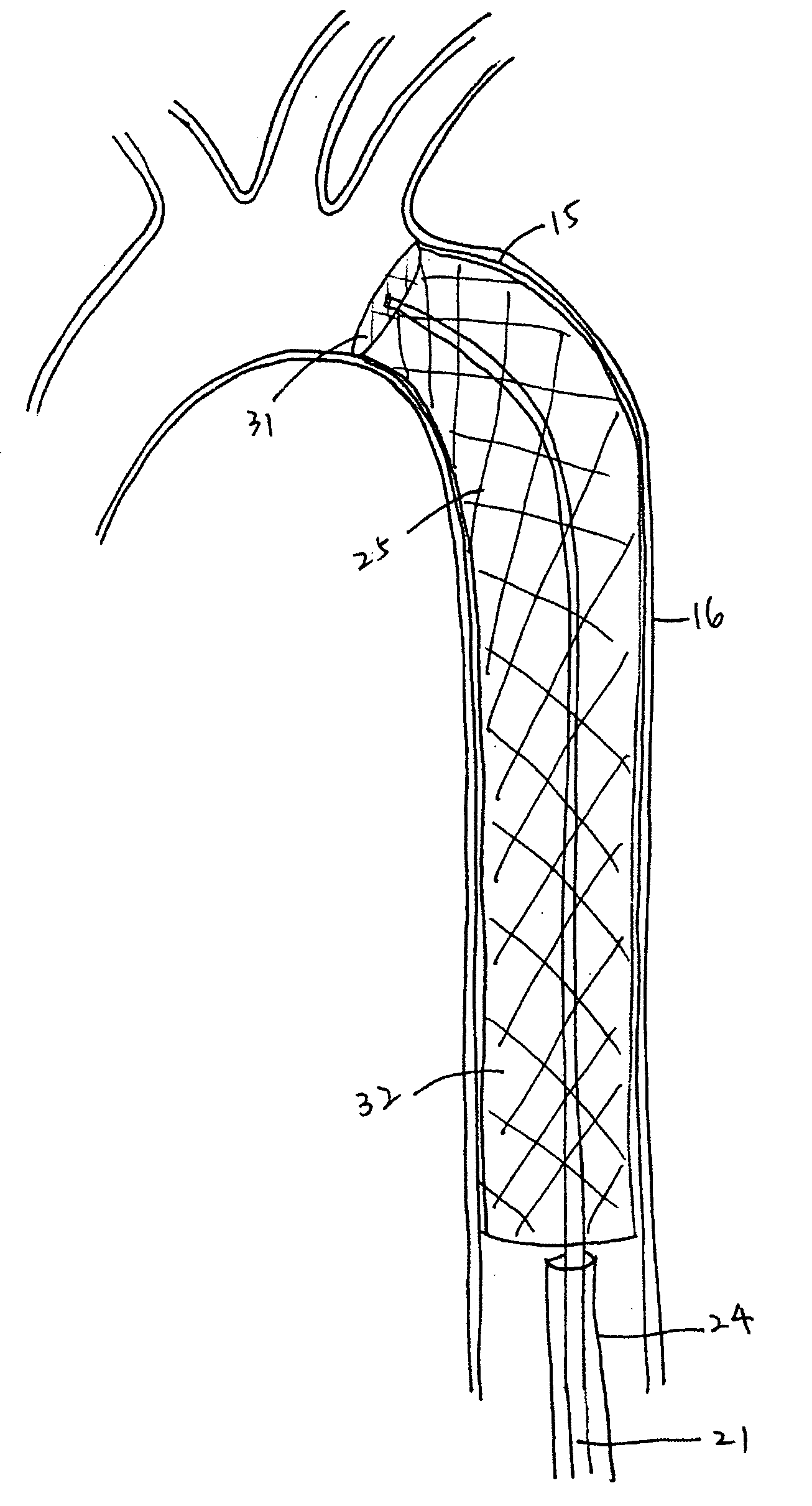 Implant for aortic dissection and methods of use