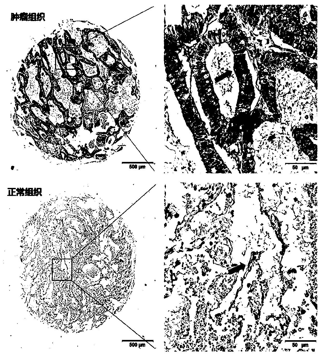 Application of ABHD6 in diagnosis, prognosis and treatment products of non-small cell lung cancer