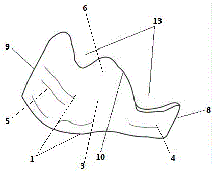 Inferior alveolar nerve protection guide plate based on mandible cystic lesion scaling