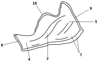 Inferior alveolar nerve protection guide plate based on mandible cystic lesion scaling