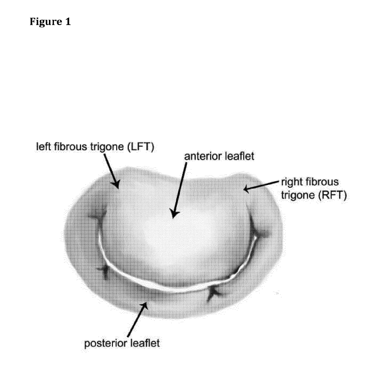 Atrio-Ventricular Valve Stent with Native Leaflet Grasping and Holding Mechanism