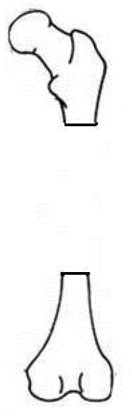 Preparation method of a titanium alloy artificial bone/intramedullary nail compression fixation system