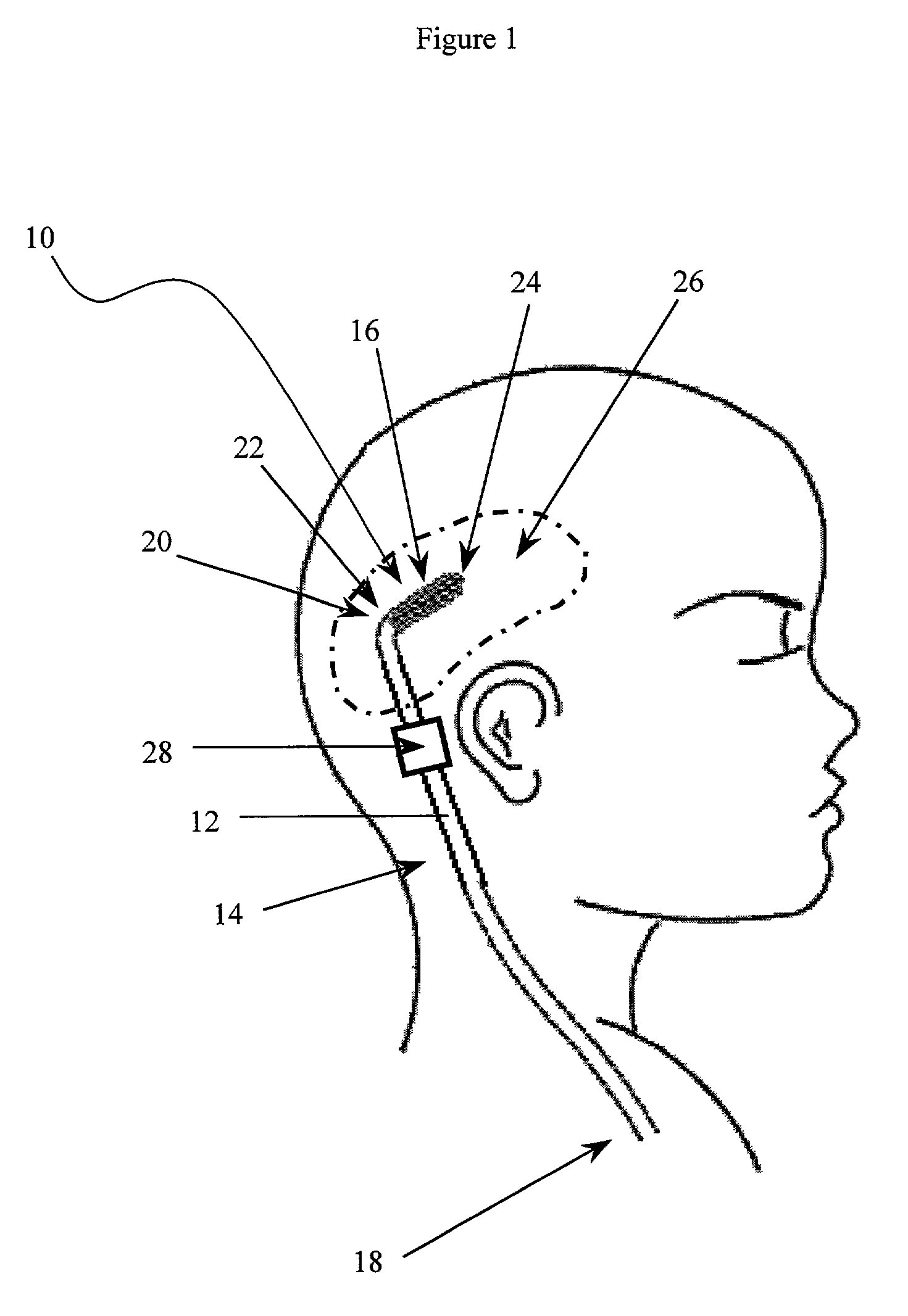 Anti-block catheter