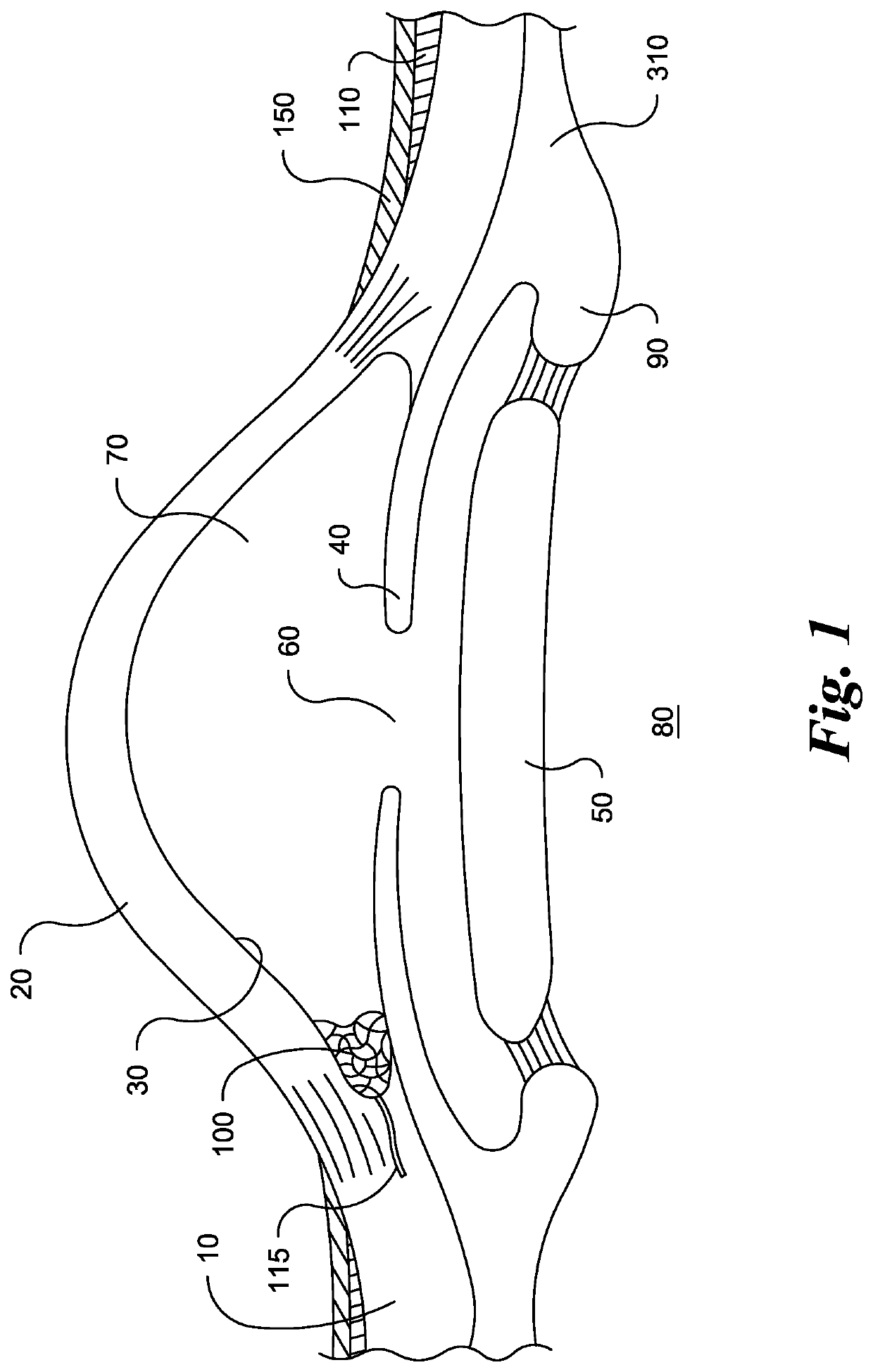 Eye implant devices and method and device for implanting such devices for treatment of glaucoma