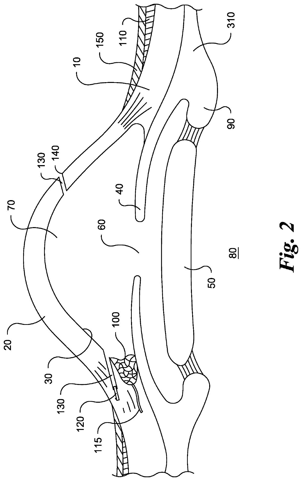 Eye implant devices and method and device for implanting such devices for treatment of glaucoma