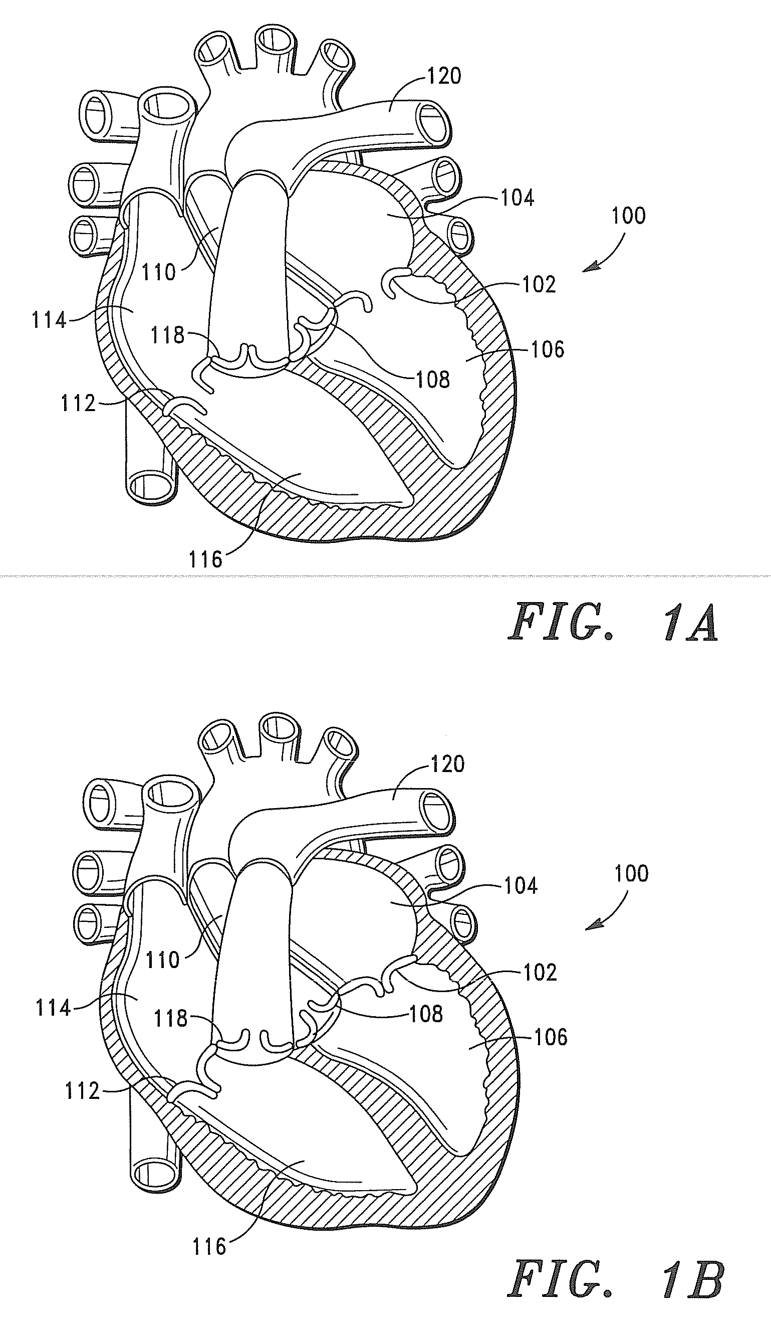 Prosthetic Tissue Valves