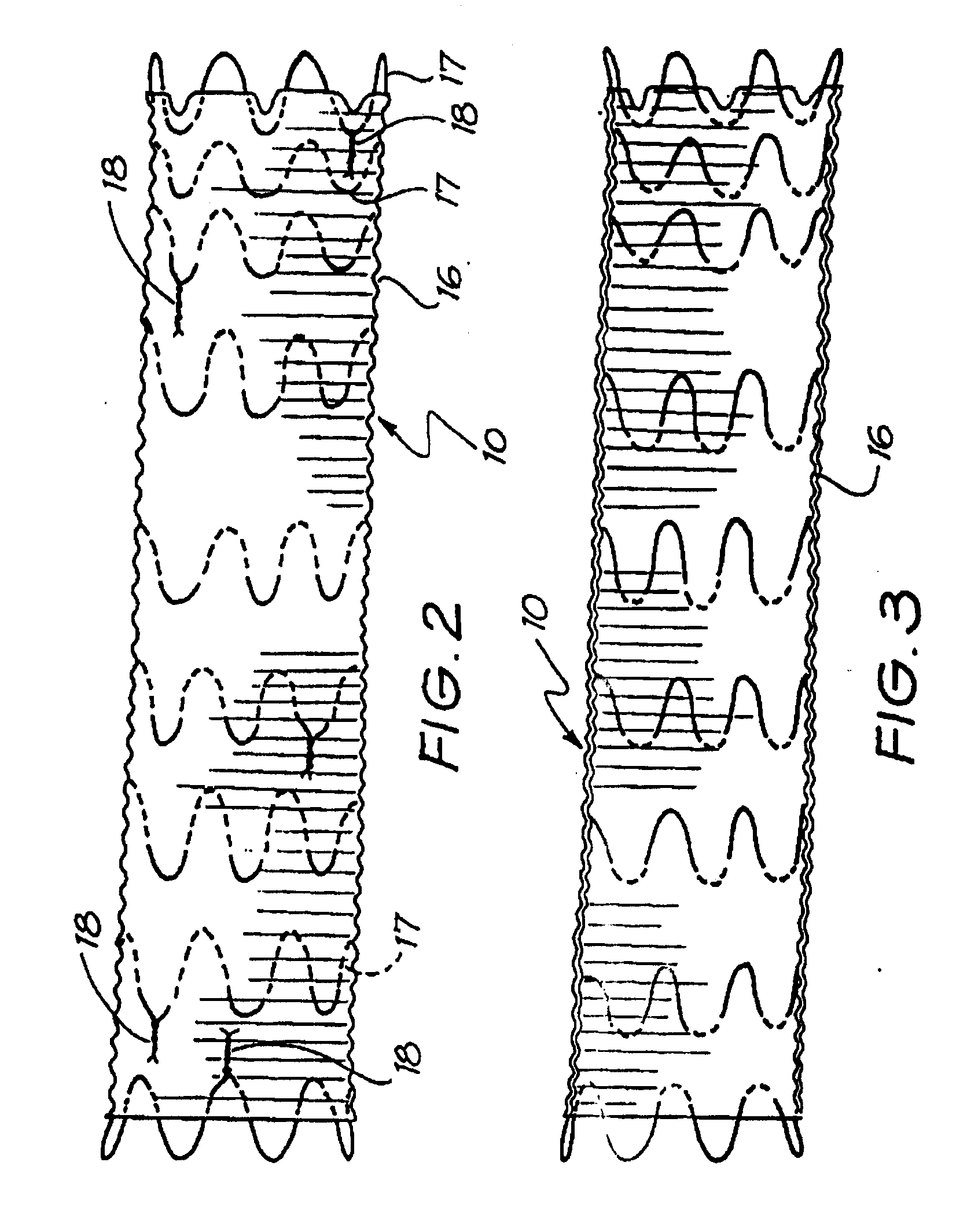 Intraluminal Graft