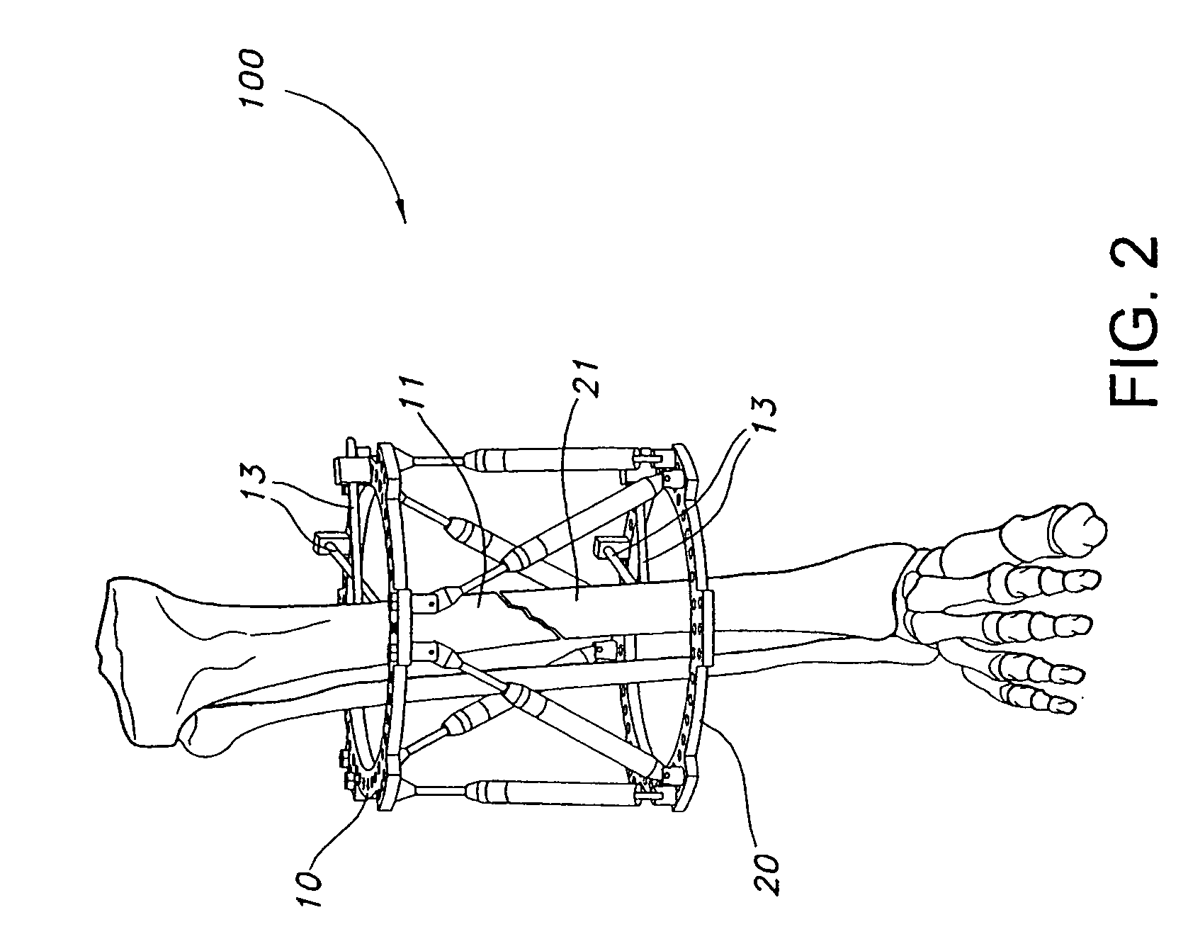 Orthopaedic fixation method and device with delivery and presentation features