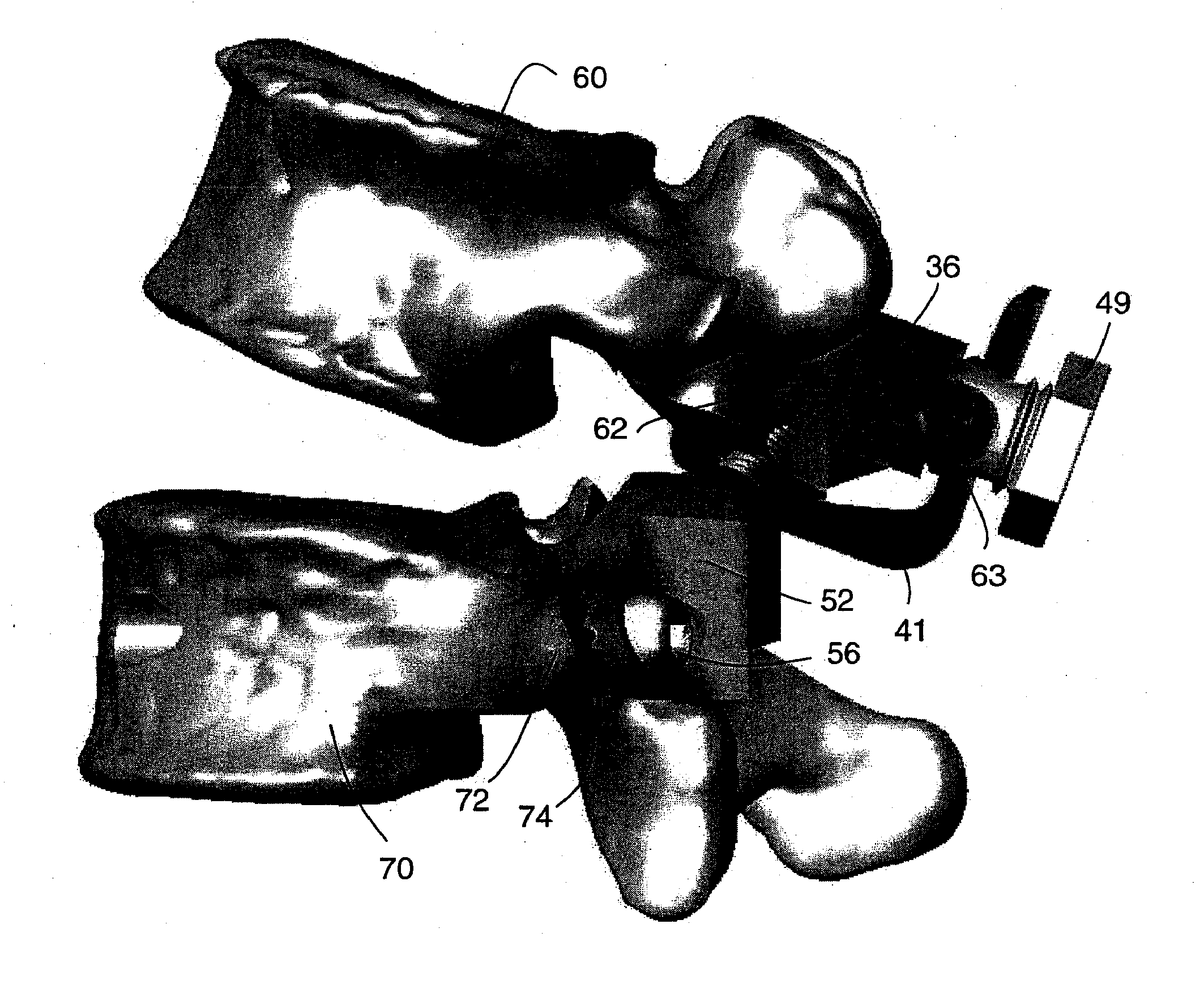 Prostheses, tools and methods for replacement of natural facet joints with artificial facet joint surfaces