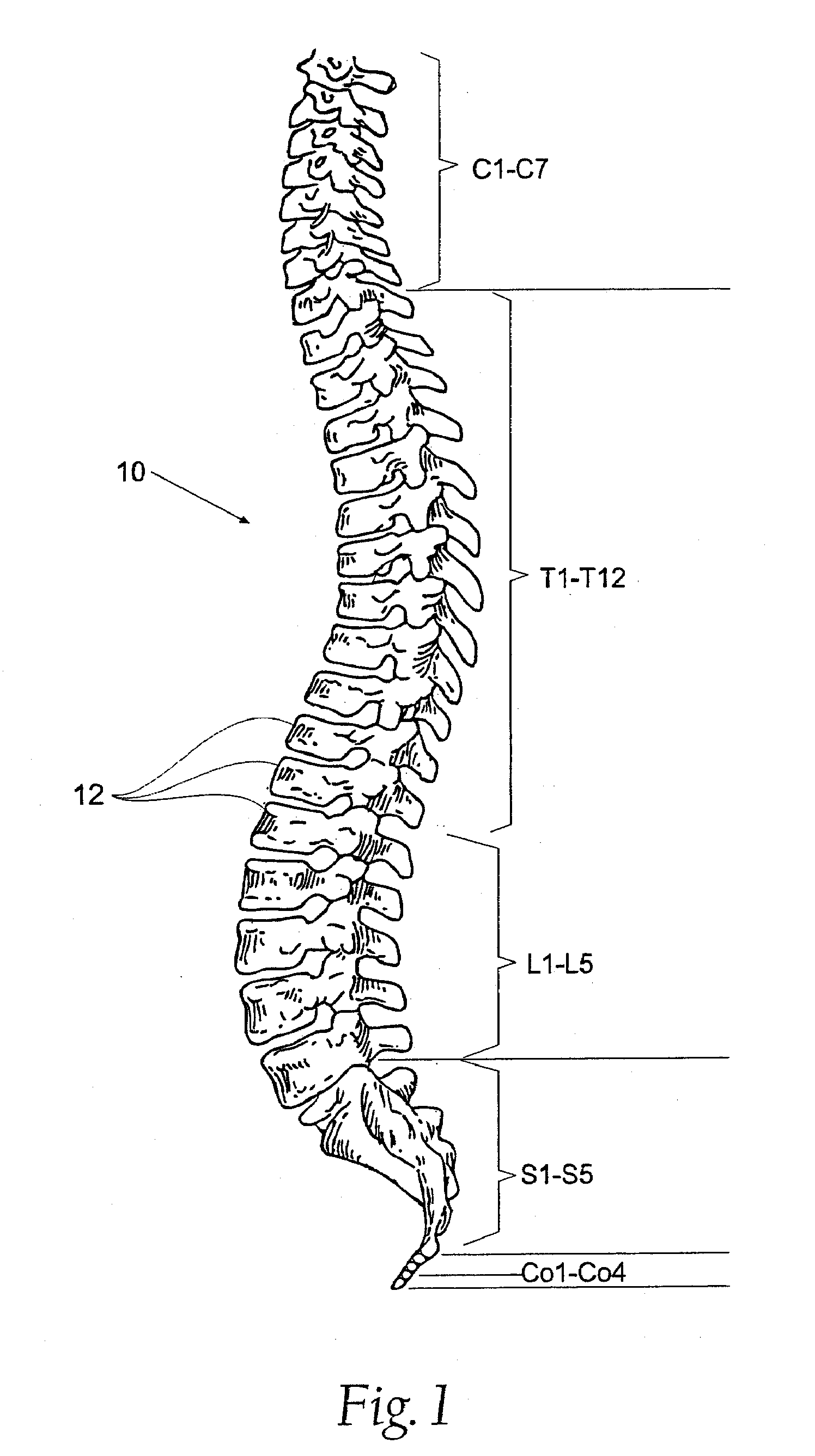 Prostheses, tools and methods for replacement of natural facet joints with artificial facet joint surfaces