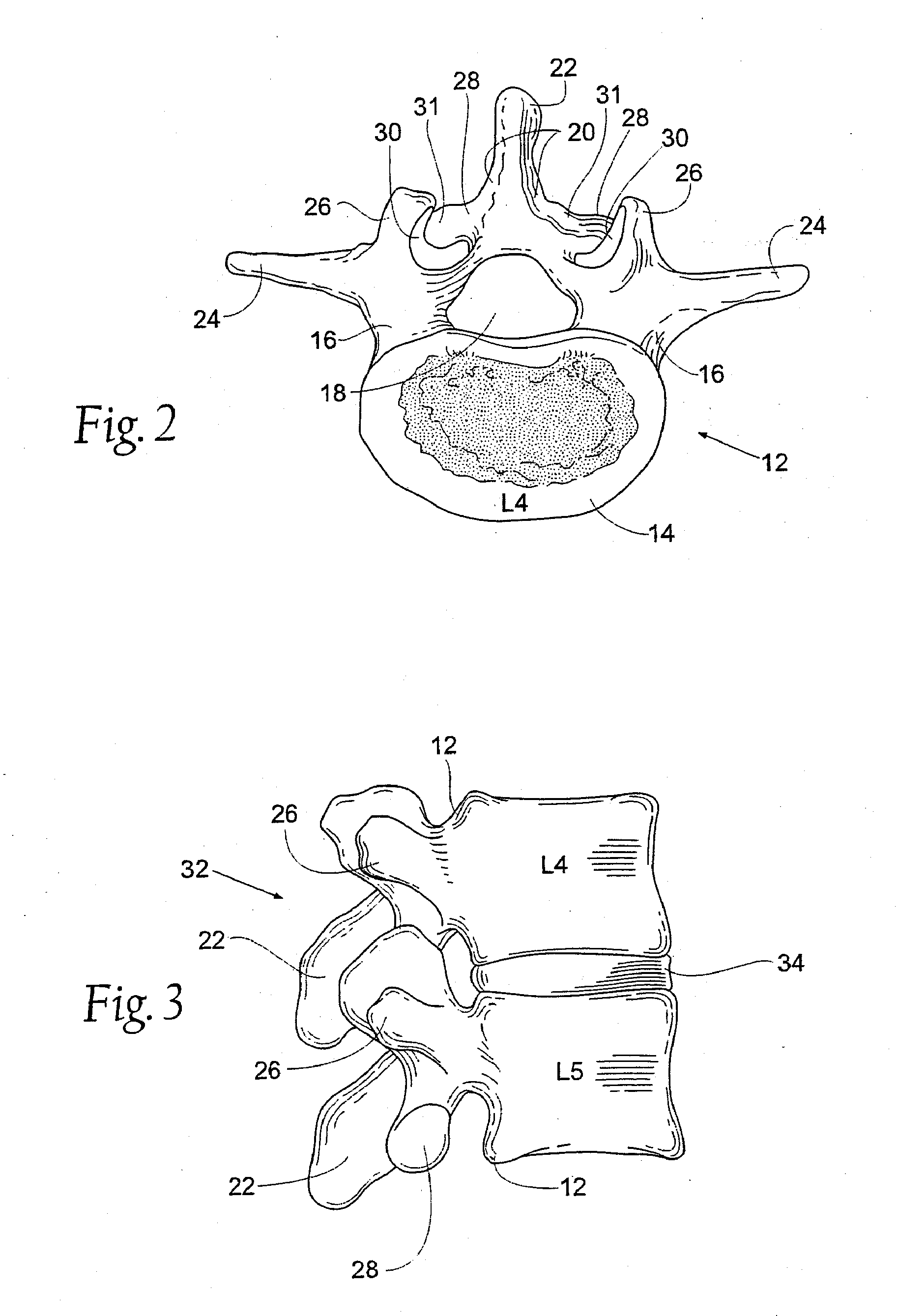 Prostheses, tools and methods for replacement of natural facet joints with artificial facet joint surfaces