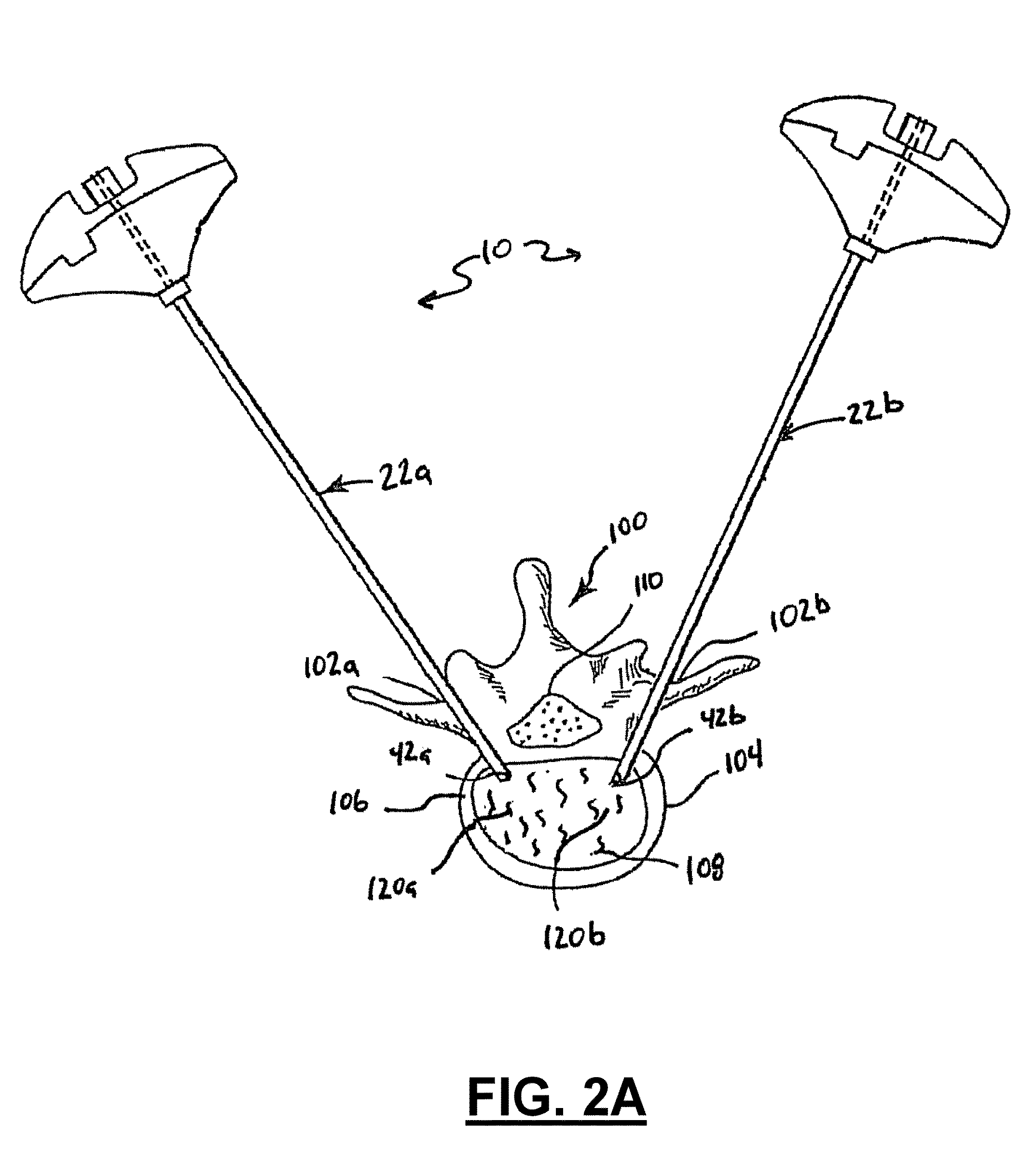 Method for balloon-aided vertebral augmentation