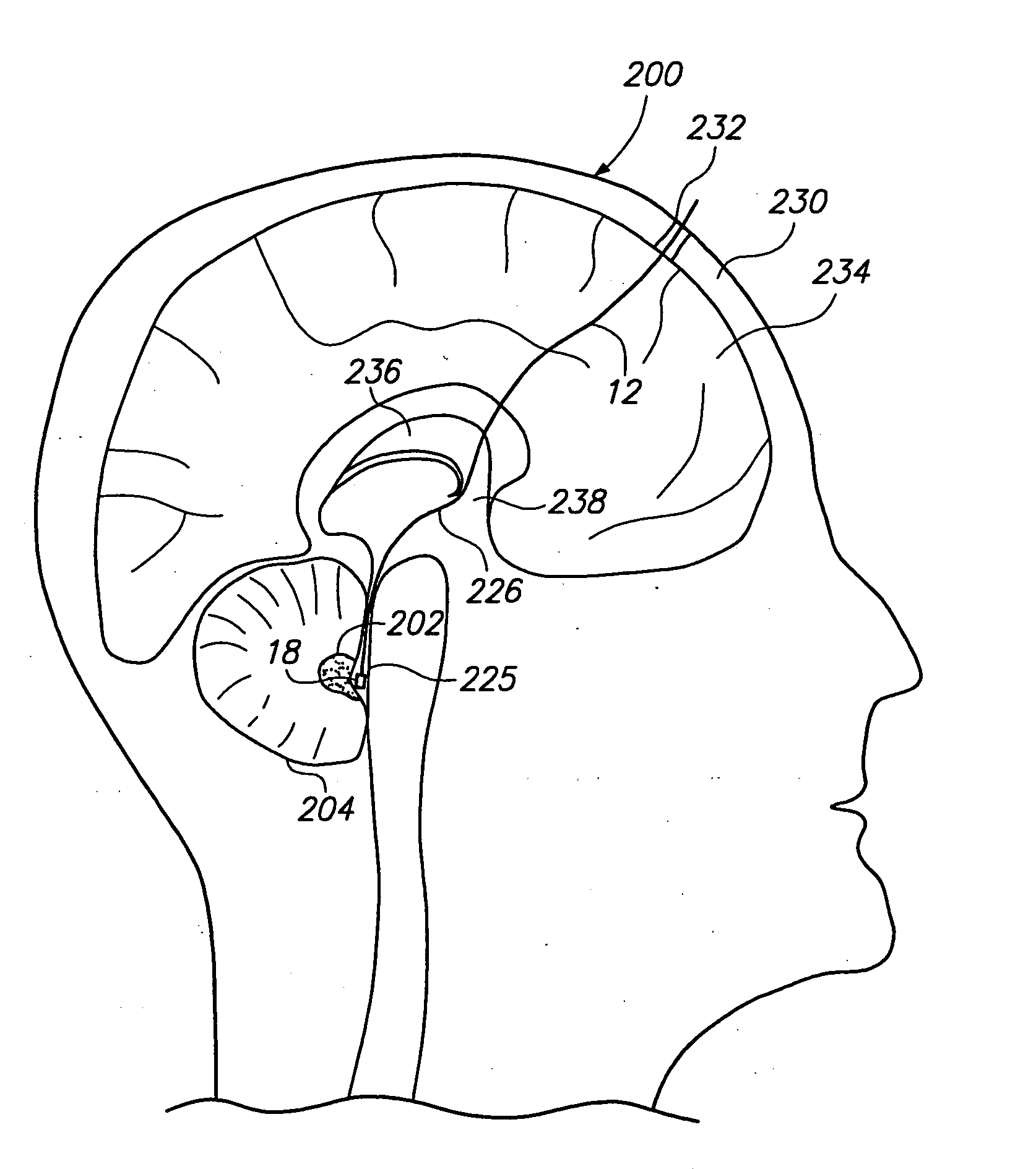 Method of stimulating fastigium nucleus to treat neurological disorders