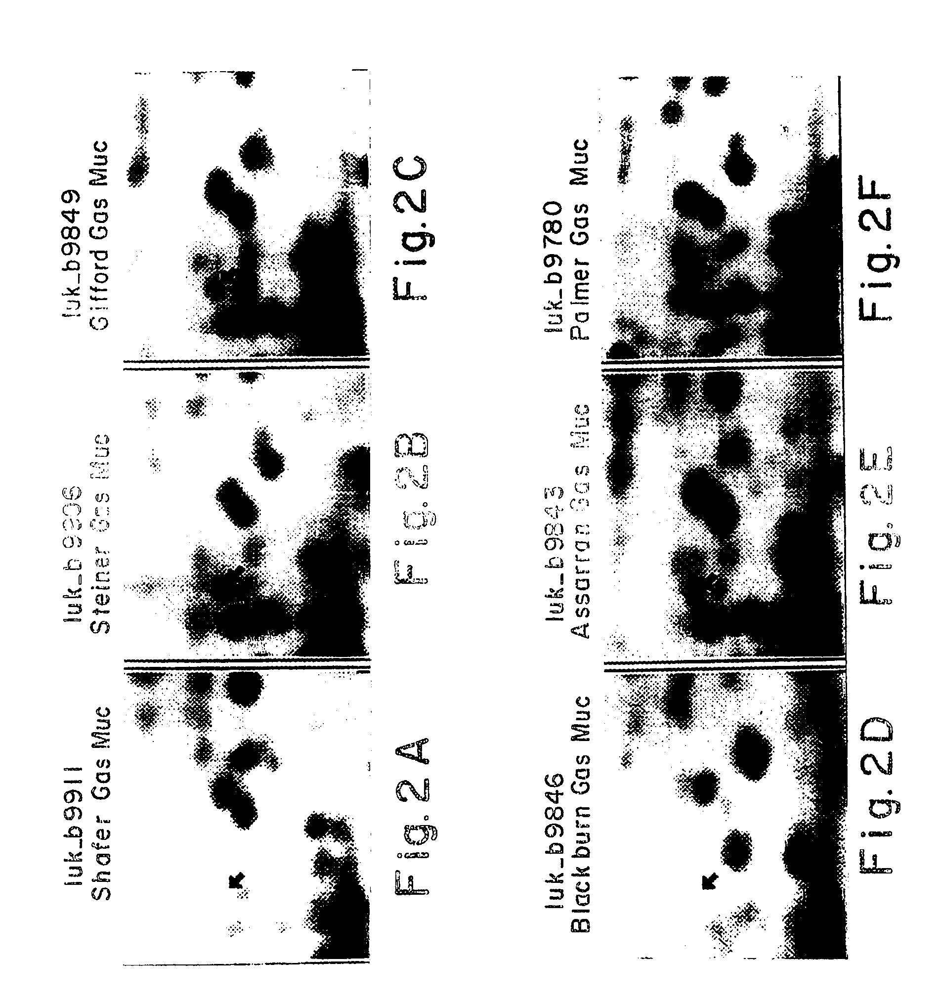 Protein markers for esophageal cancer