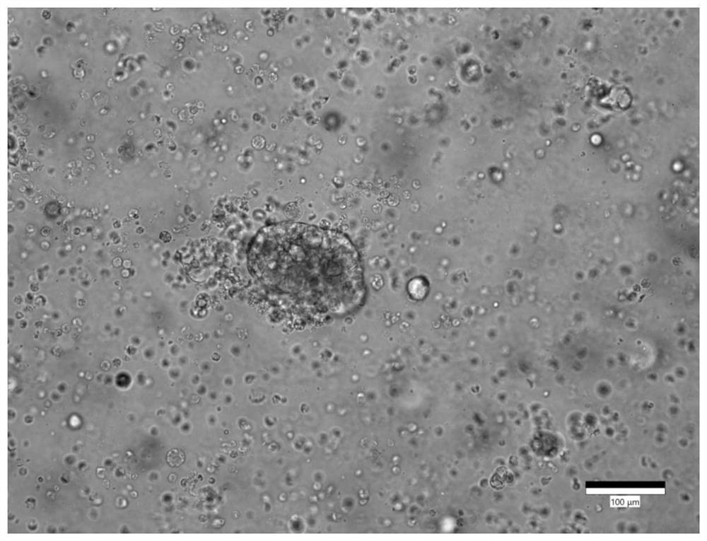 A kind of culture medium and culture method of gastric cancer organoids