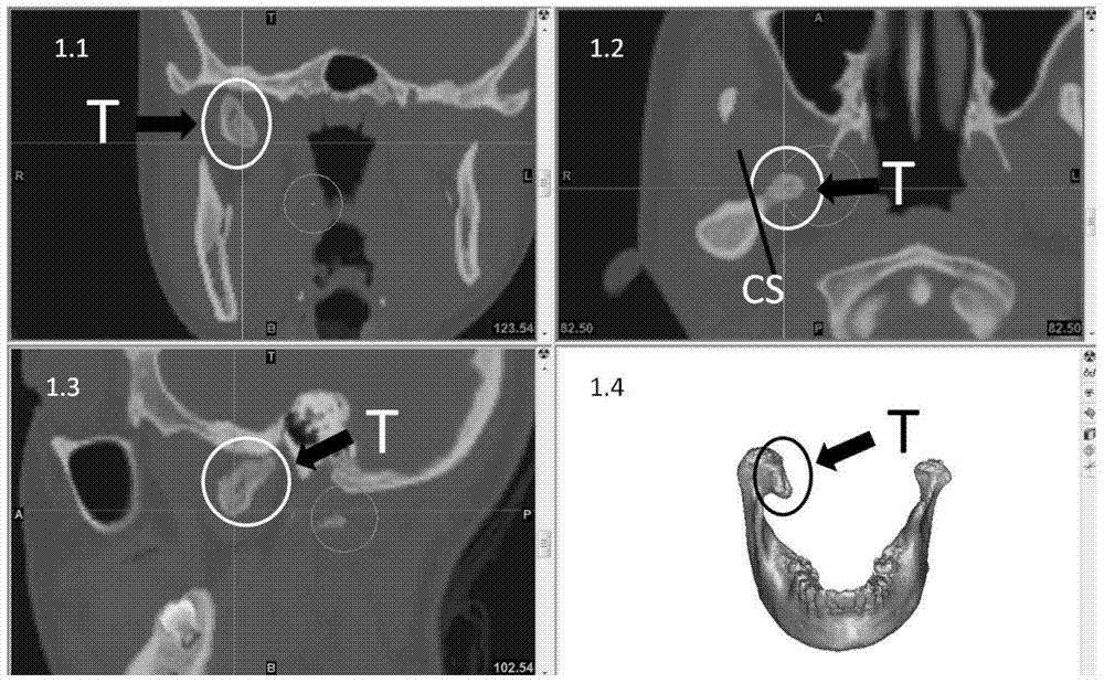 Application of digitization technology to oral approach mandibular condylar lesion surgical excision