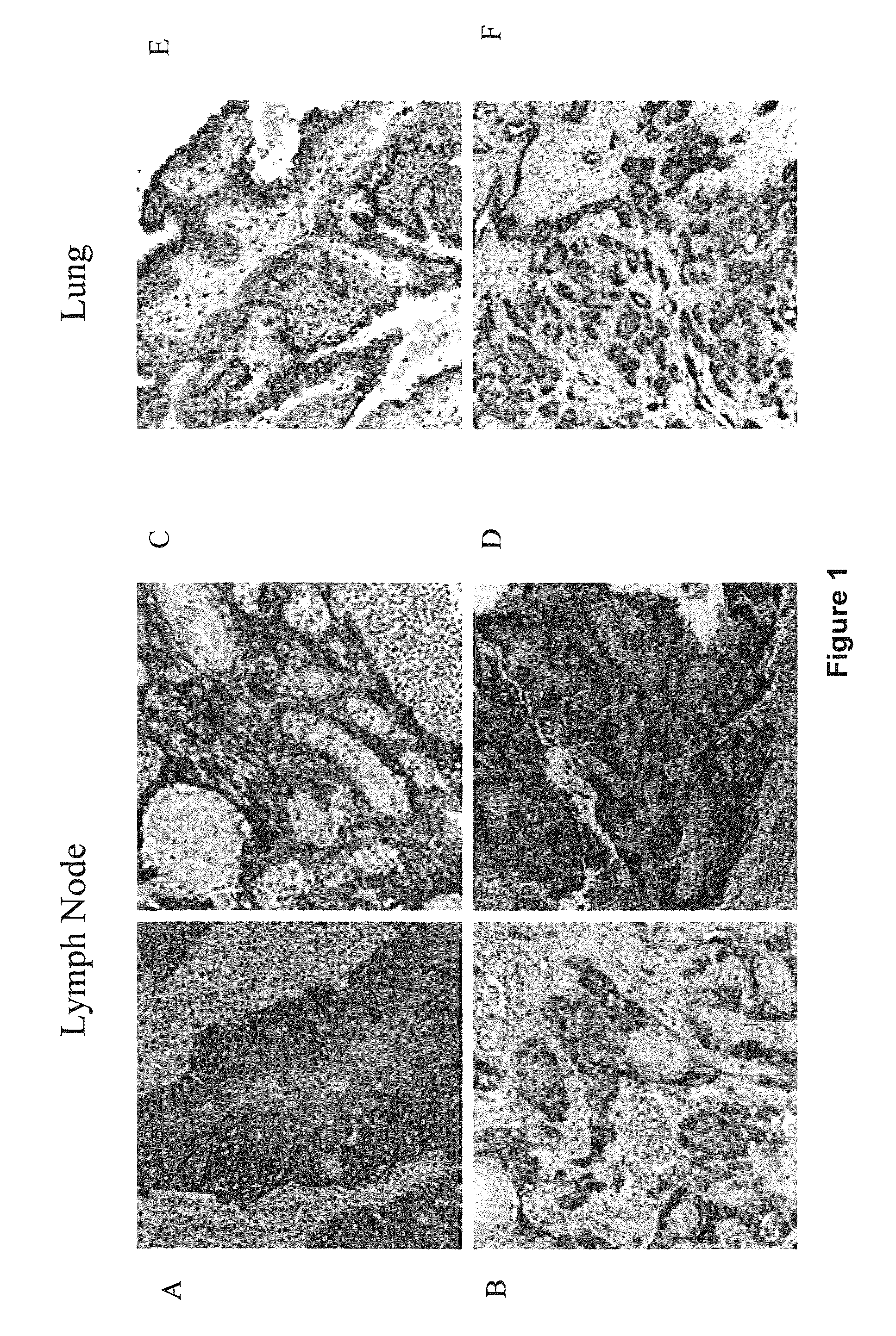 Compositions and Methods for Inhibiting Growth of SMAD-4 Deficient Cancers