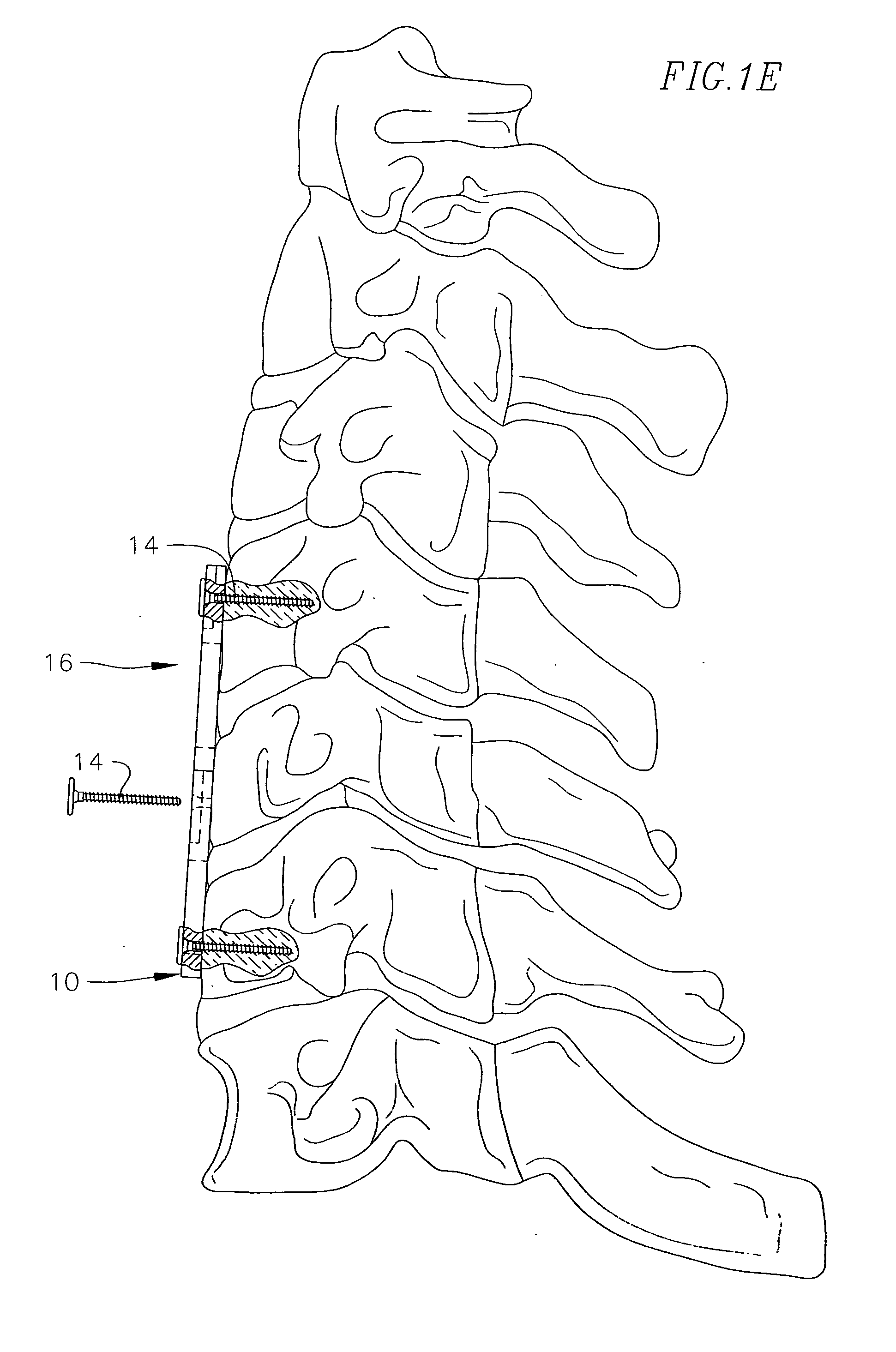 Revisable anterior cervical plating system