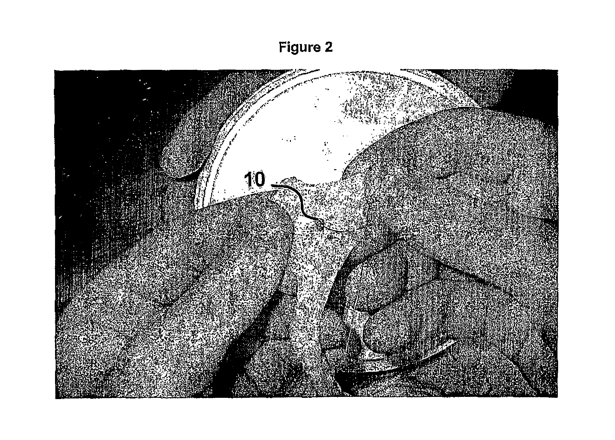 Method and device for the controlled delivery and placement of securing elements in a body