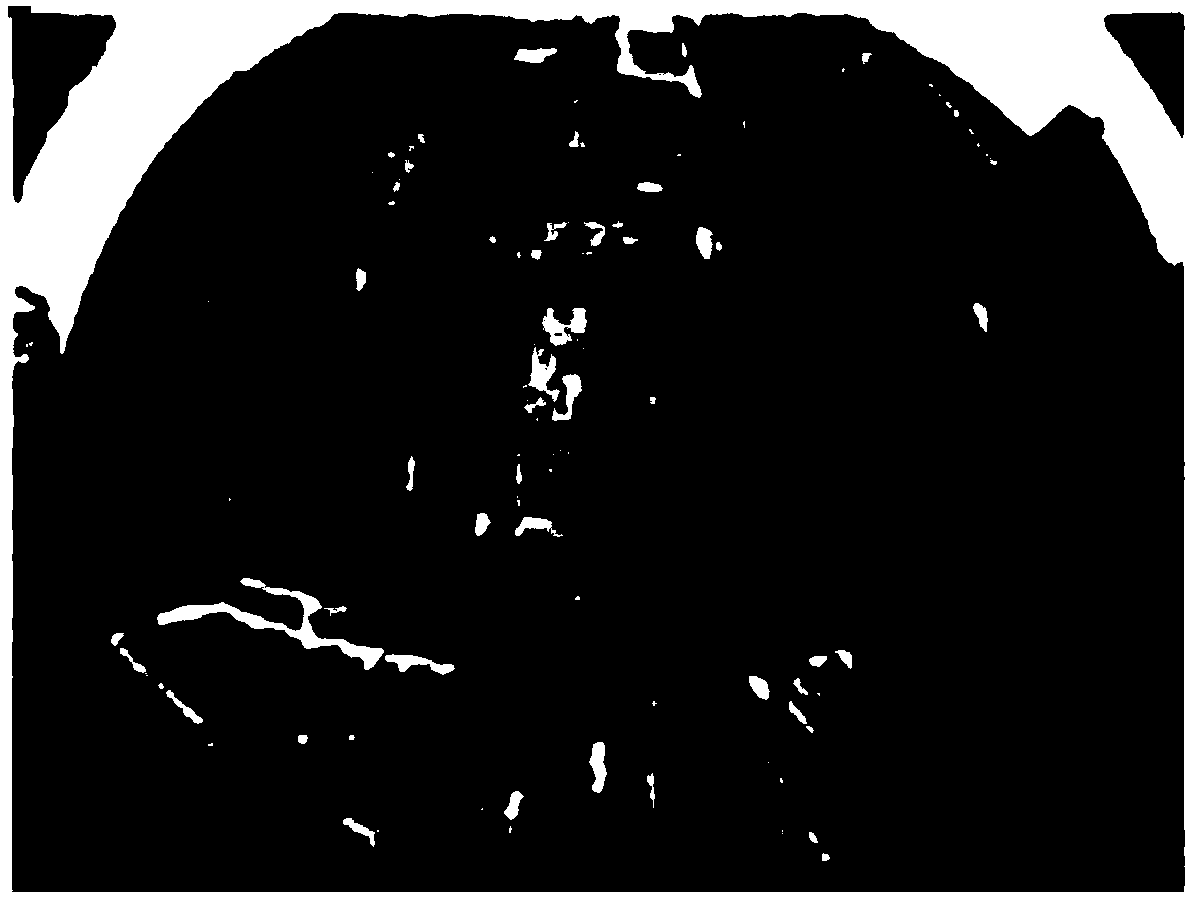 Lens radial distortion correction method