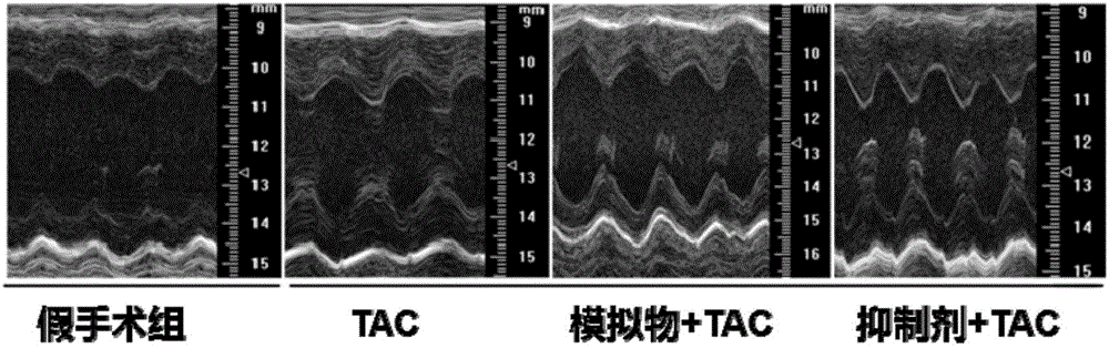 Application of miR-378 in inhibition of cardiac hypertrophy and myocardial fibrosis and diagnosis of heart failure