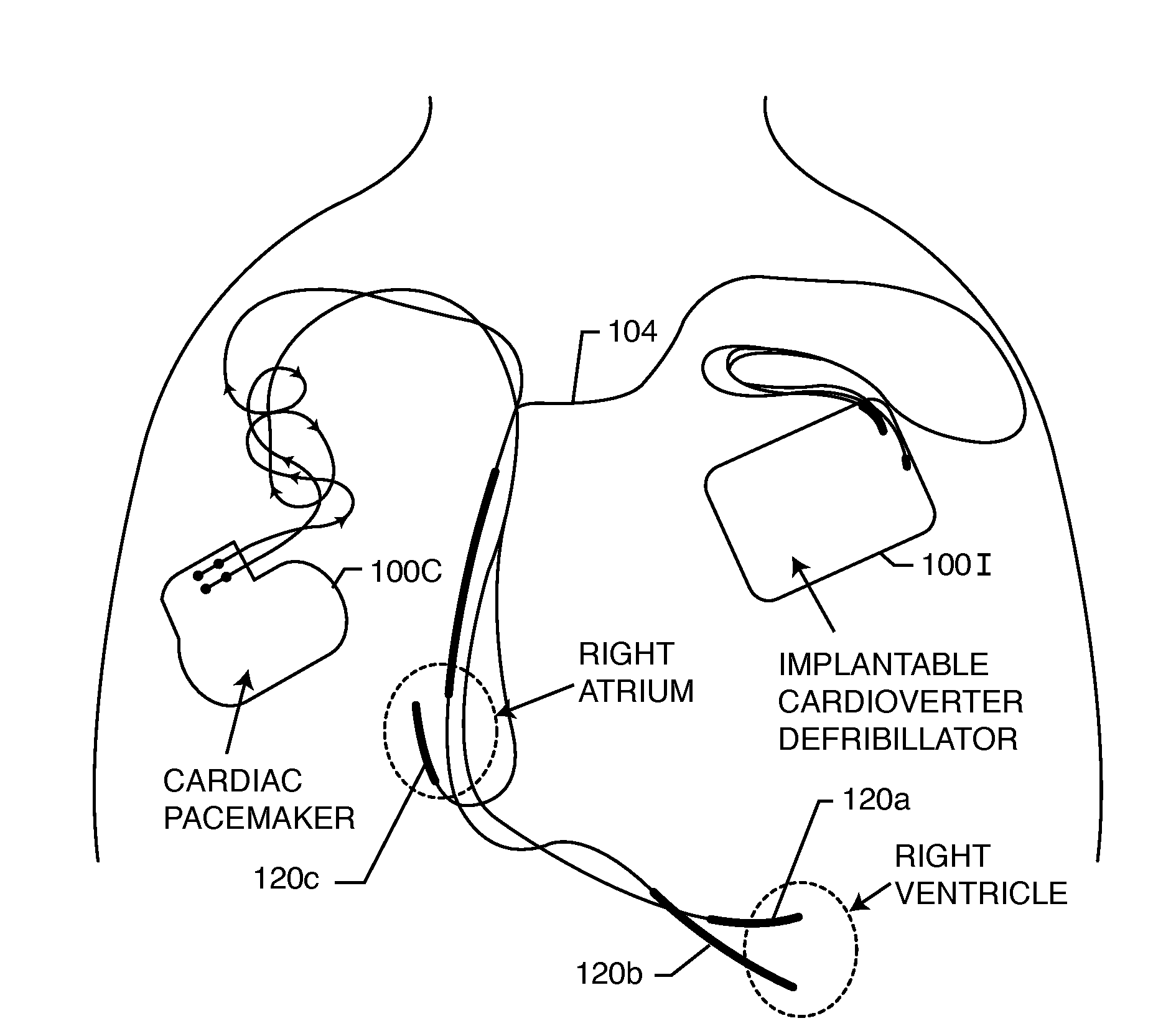 Multiplexer for selection of an MRI compatible band stop filter or switch placed in series with a particular therapy electrode of an active implantable medical device