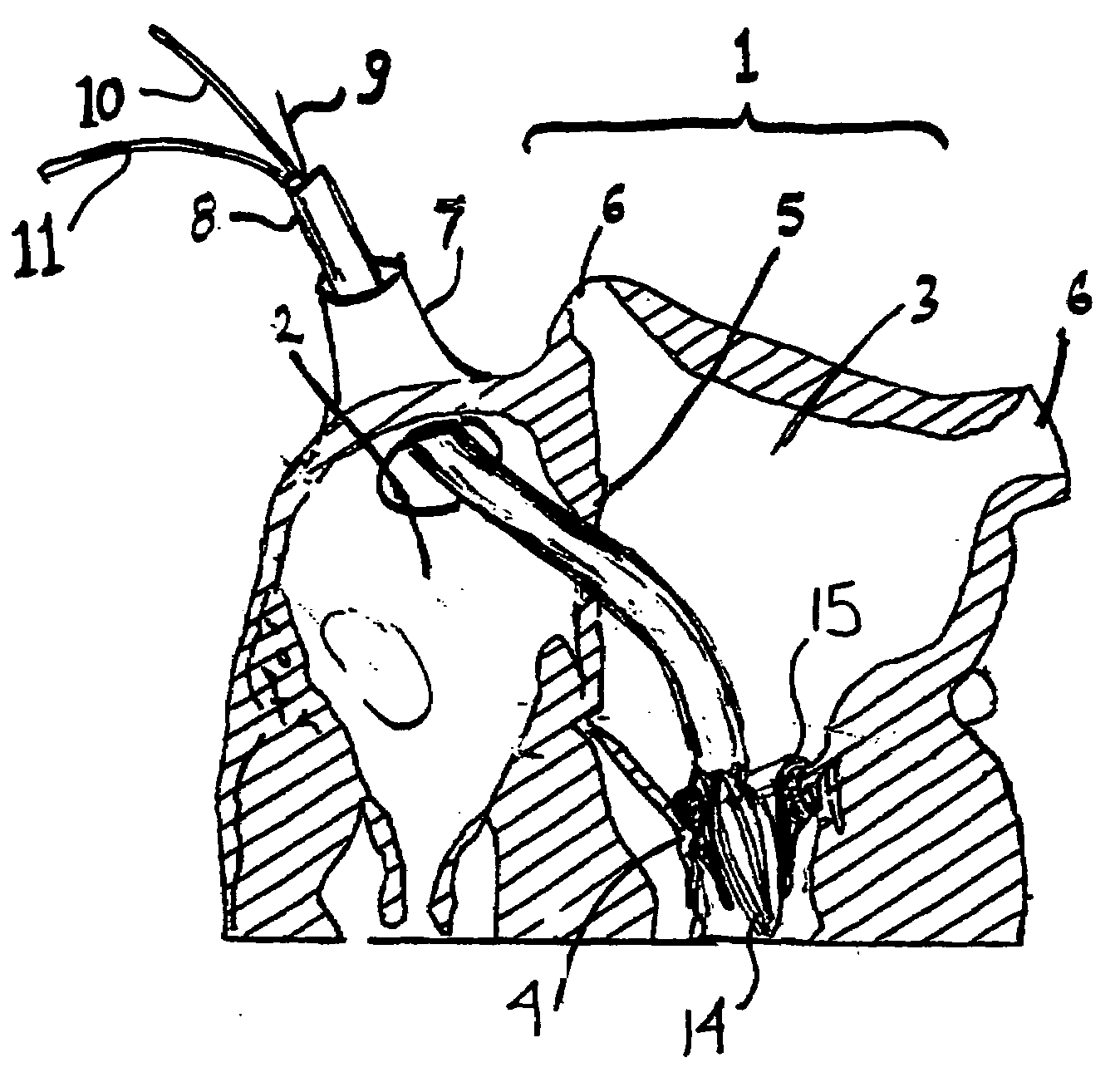 Inflatable artificial valve