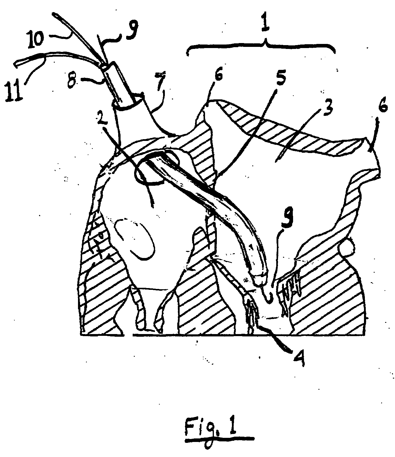 Inflatable artificial valve