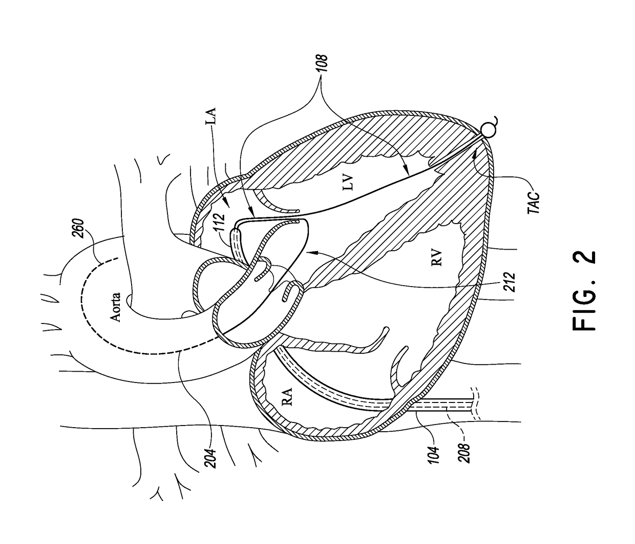 Catheter based apical approach heart prostheses delivery system