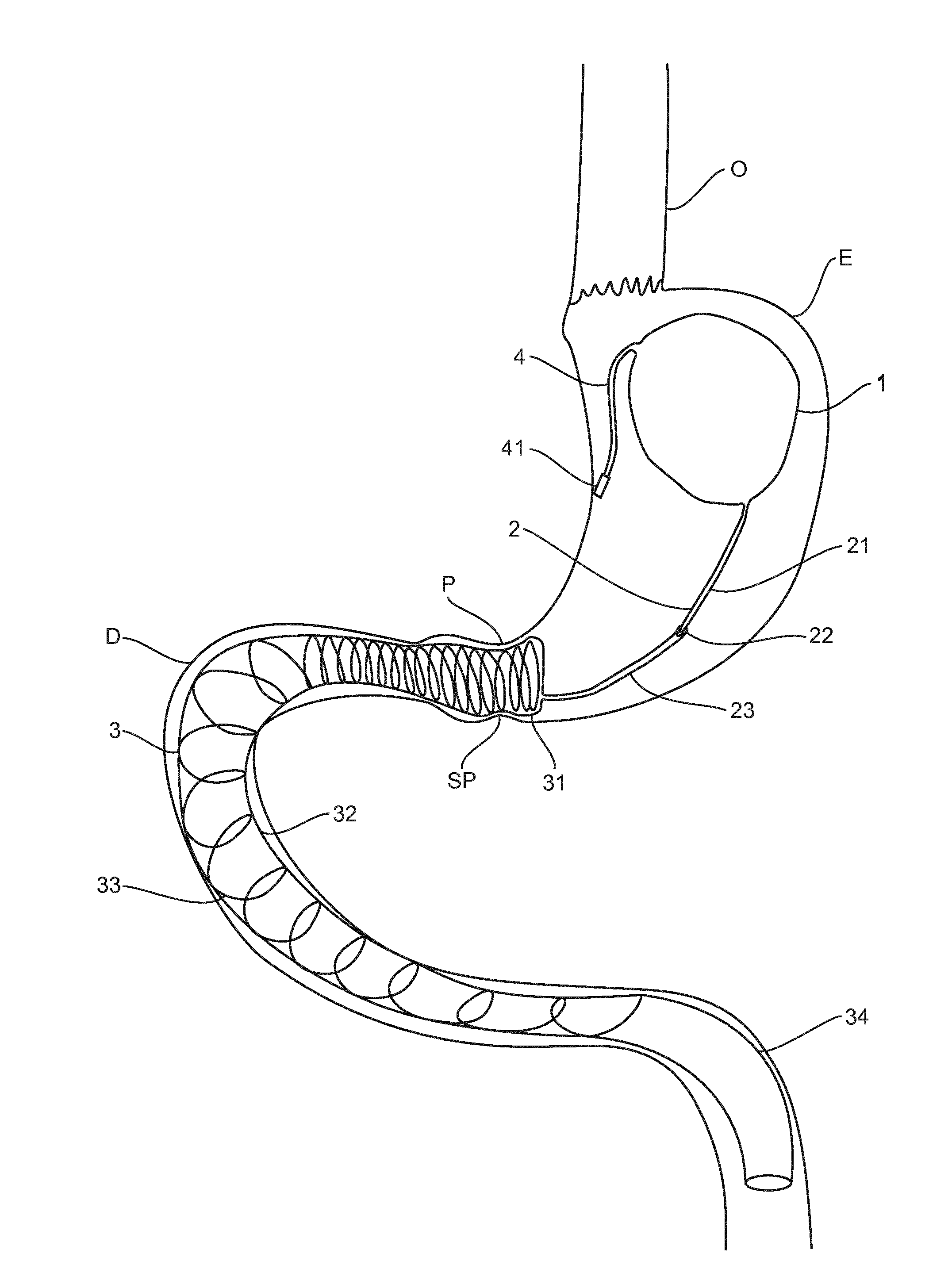 Implantable prosthetic device for weight loss in an obese or overweight patient comprising an inflatable gastric balloon and a duodenal prosthesis