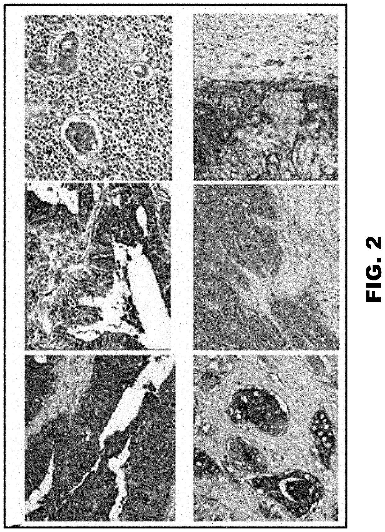 Incompatible blood group antigen for cancer detection and treatment