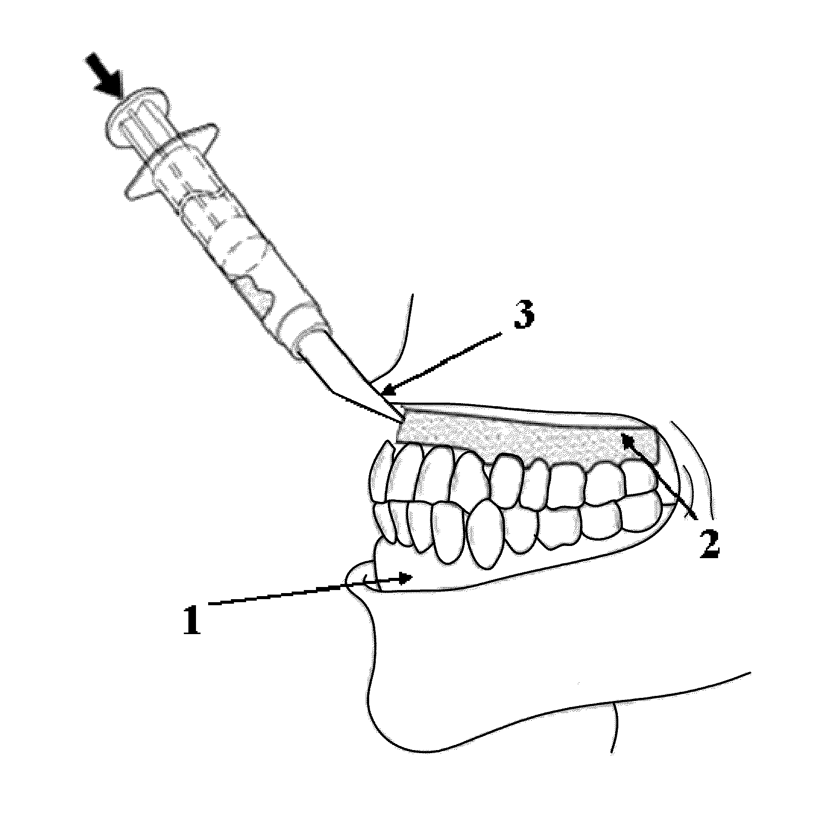 Composition for dental barrier comprising at least one monomer, at least one polymerization initiating system, and at least one indicator enabling the polymerization reaction to be monitored