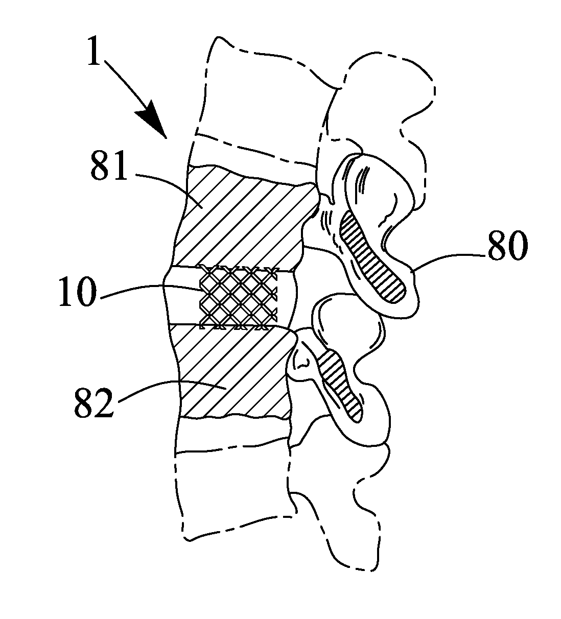 Textured implant device