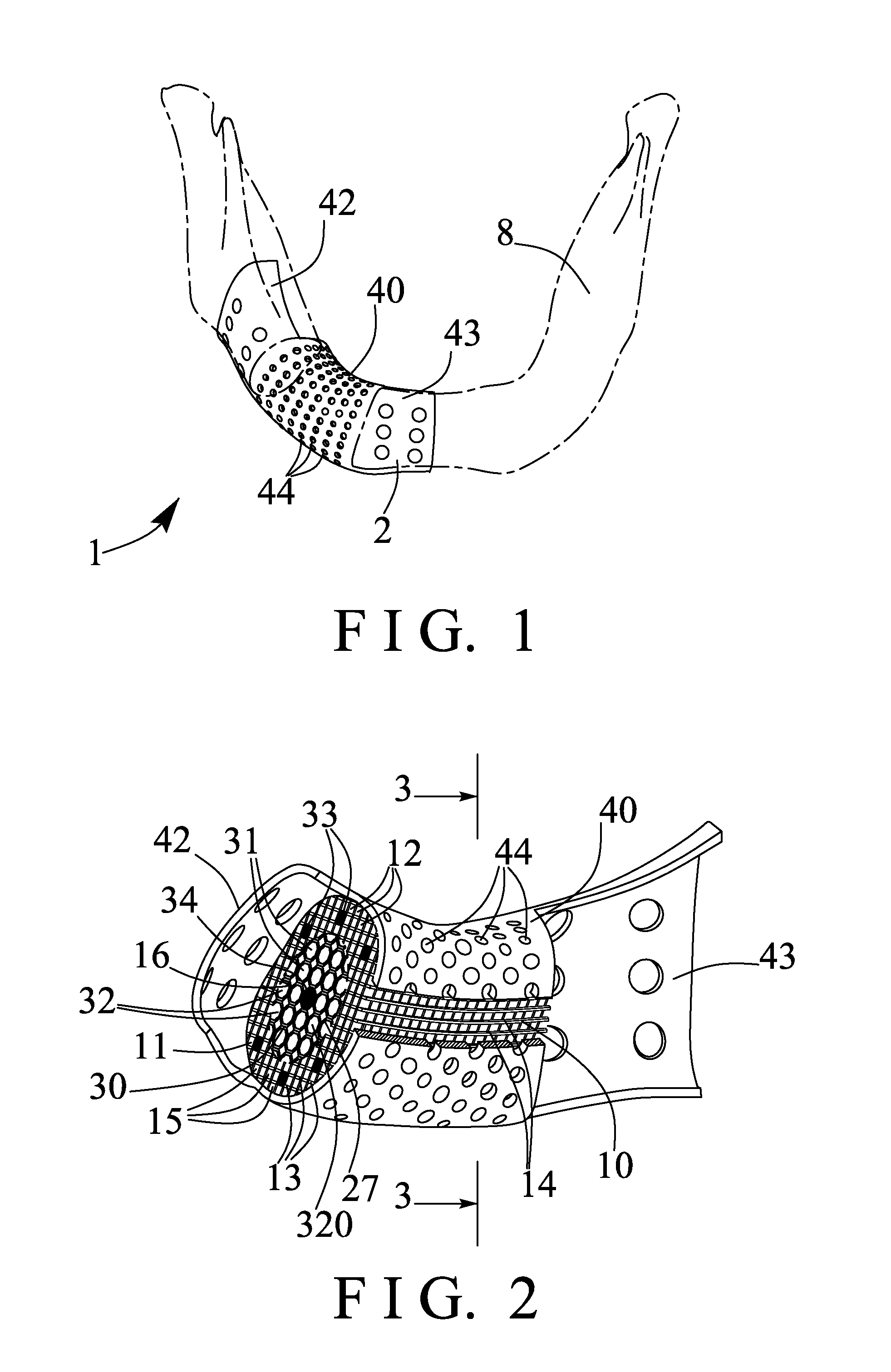 Textured implant device