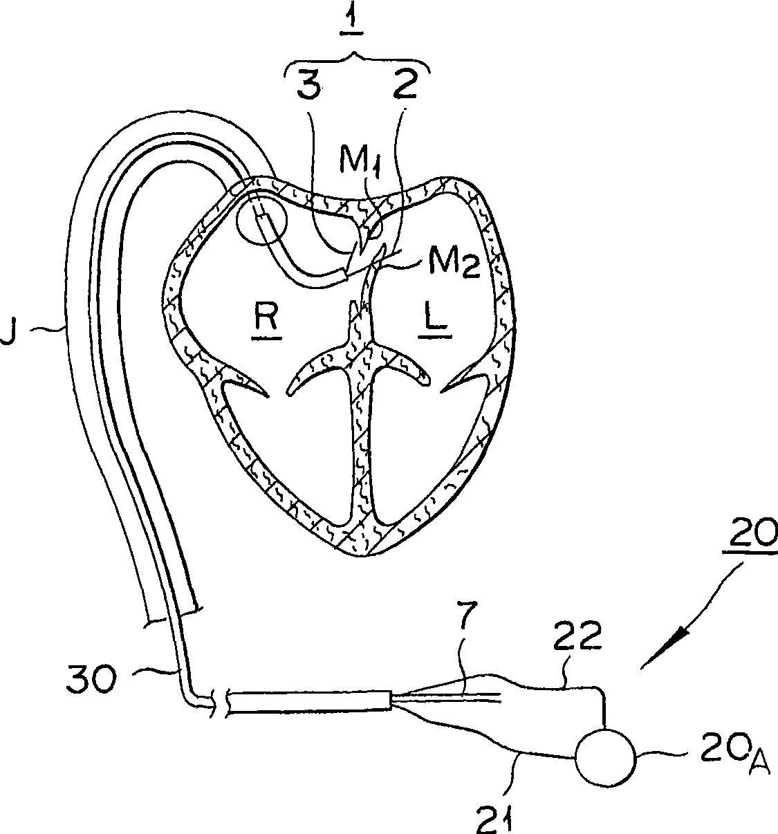 Pfo closing device