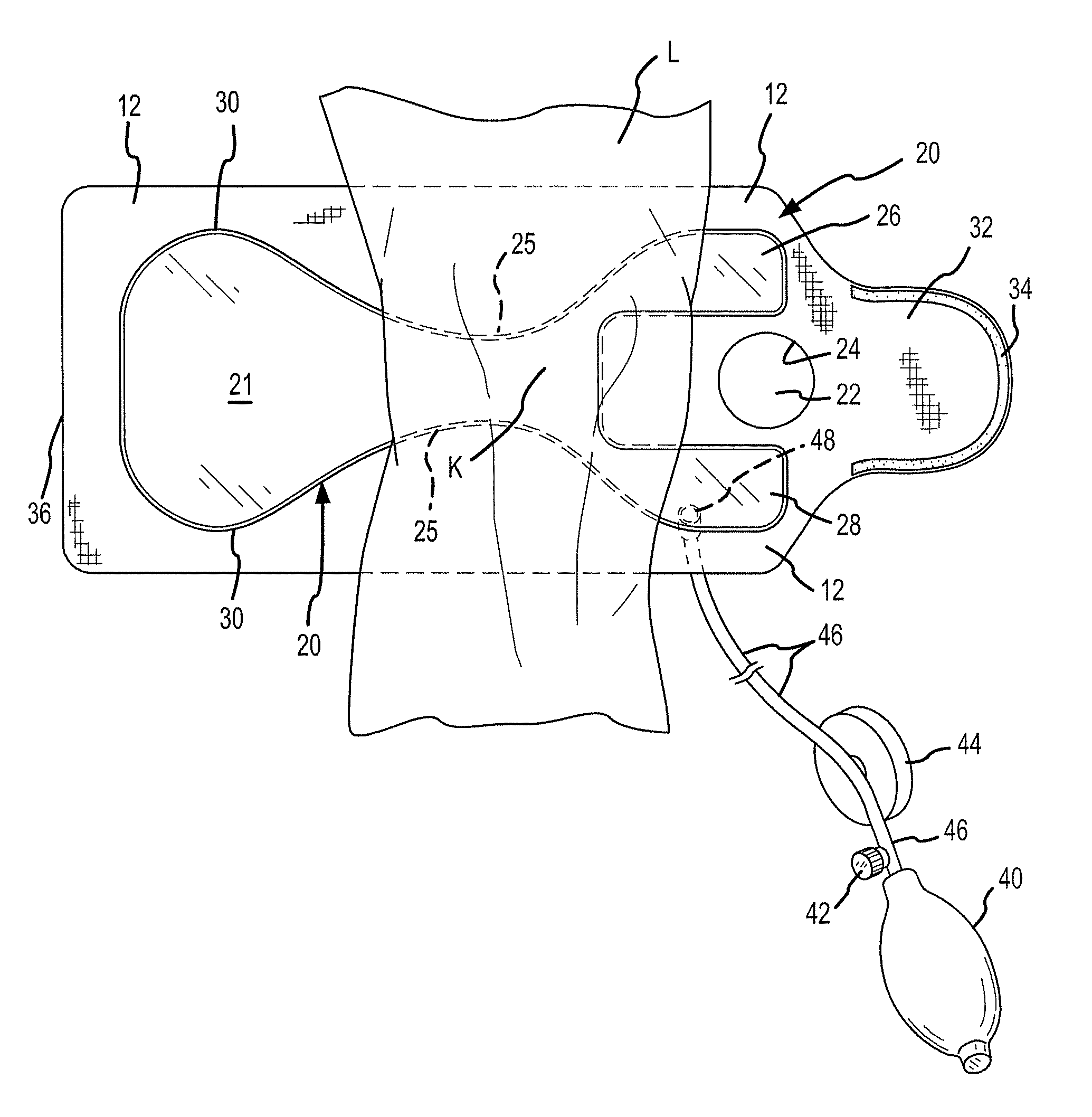 Joint aspirate facilitating device