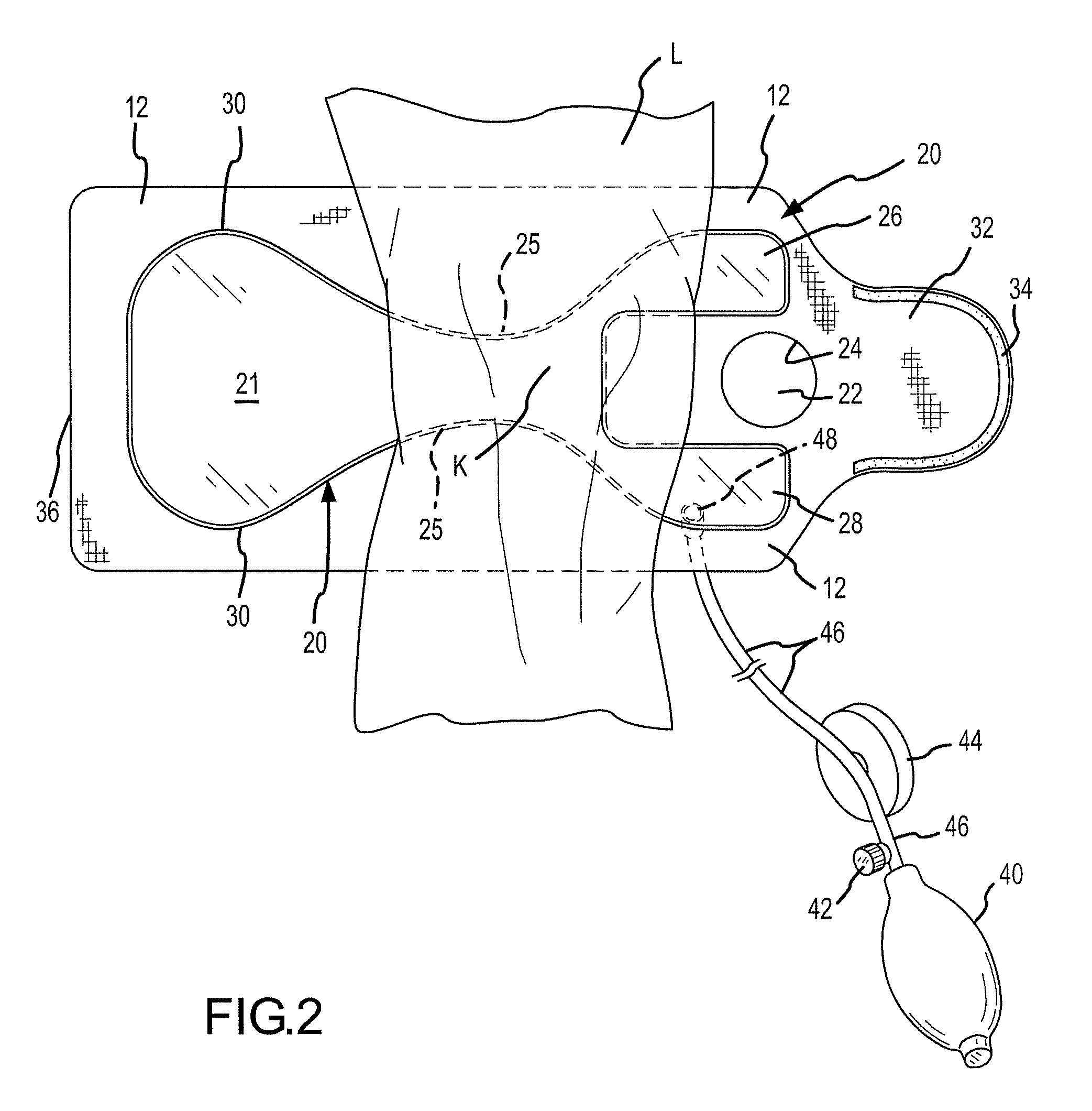 Joint aspirate facilitating device