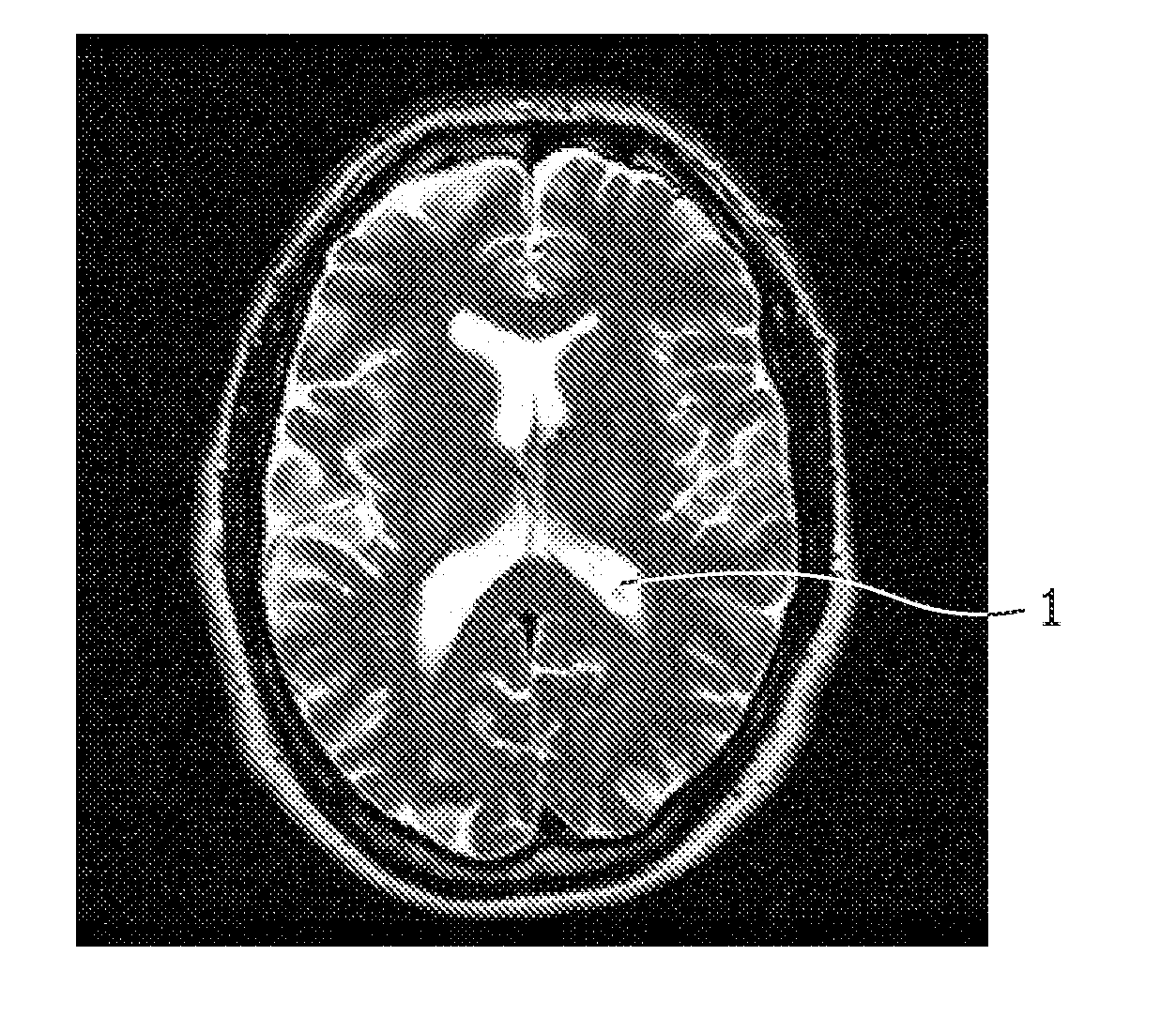 Brain ventricle analysis