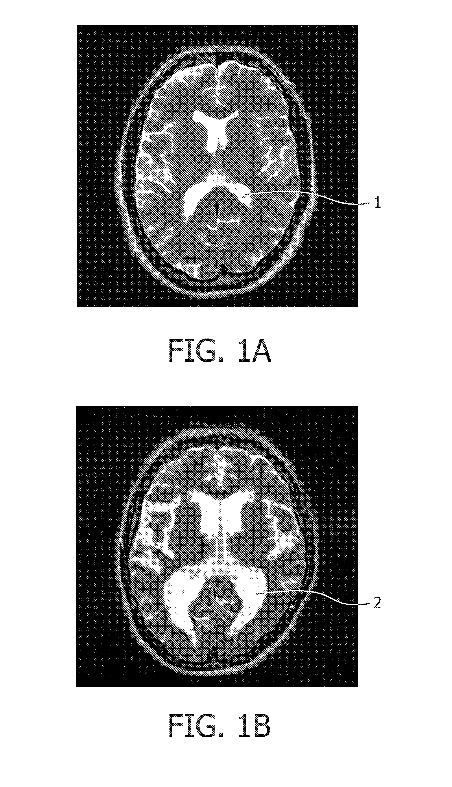 Brain ventricle analysis