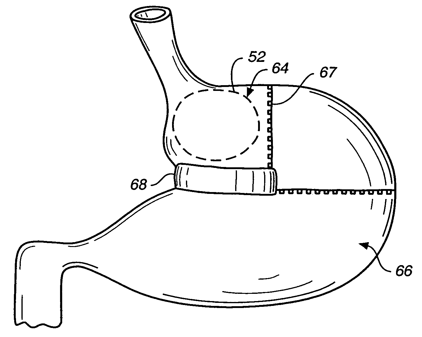 Methods and devices for maintaining a space occupying device in a relatively fixed location within a stomach