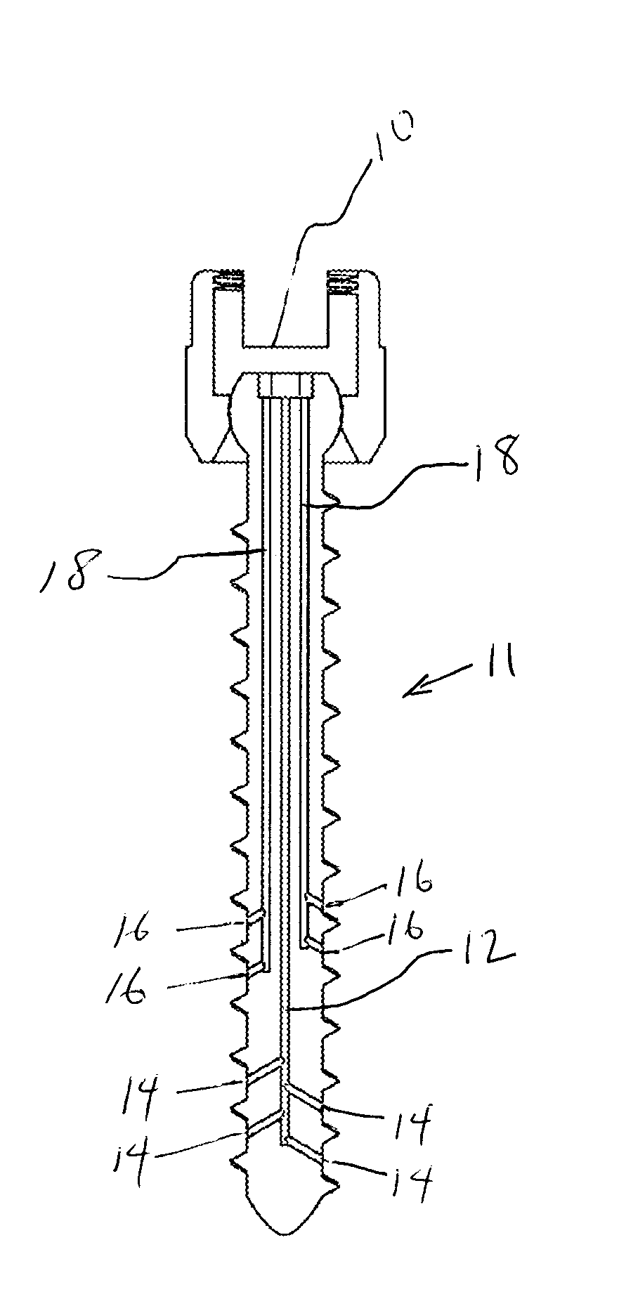 Venting/pressure adjustment to aid in delivery of material into an anatomic region via a cannula