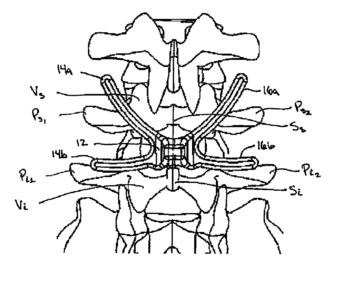 Posterior dynamic stabilization systems and methods