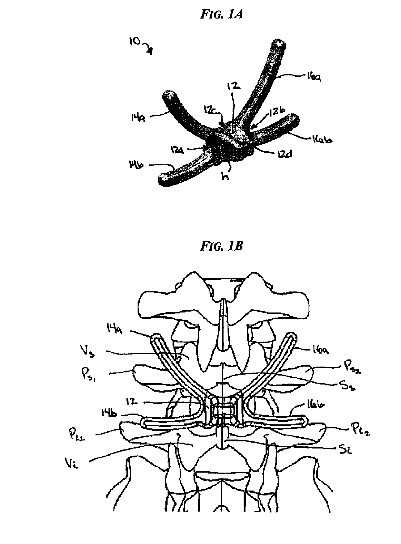 Posterior dynamic stabilization systems and methods