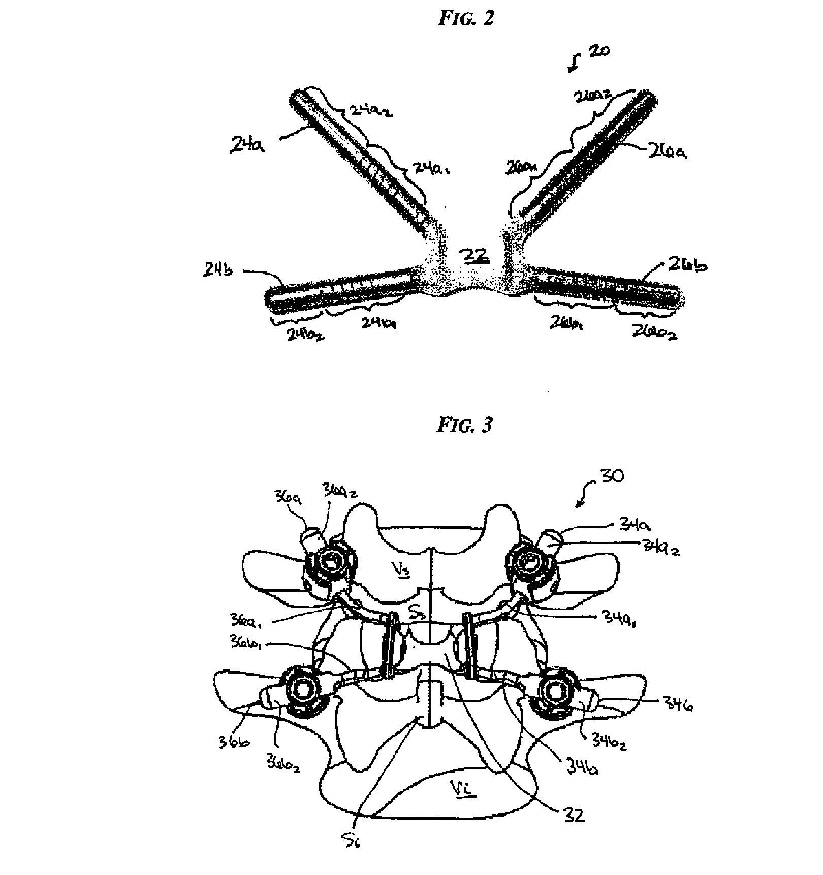 Posterior dynamic stabilization systems and methods