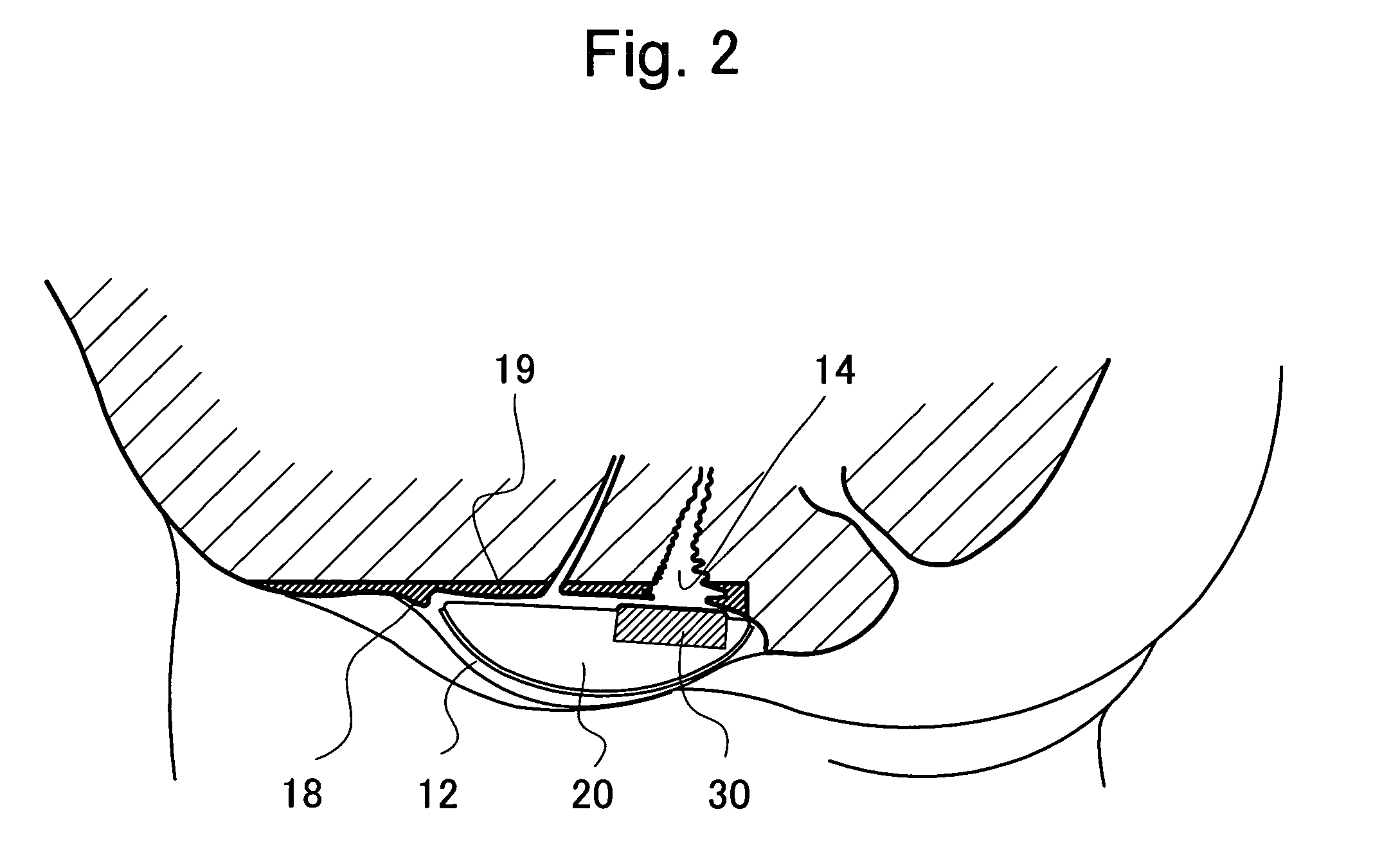 Interlabial pad